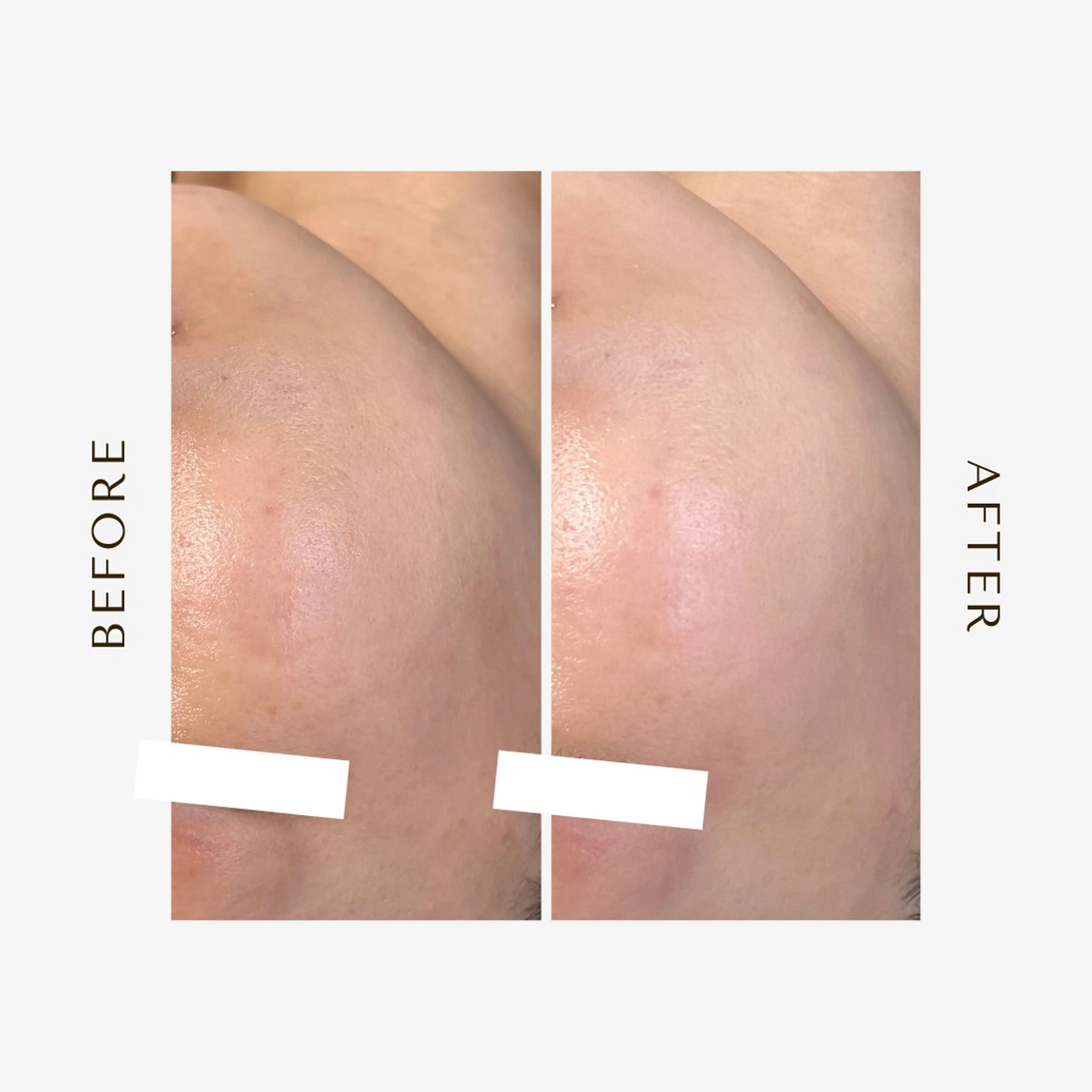 脱毛 1st｜フェイシャル エステ専門店のエステ・リラクイメージ