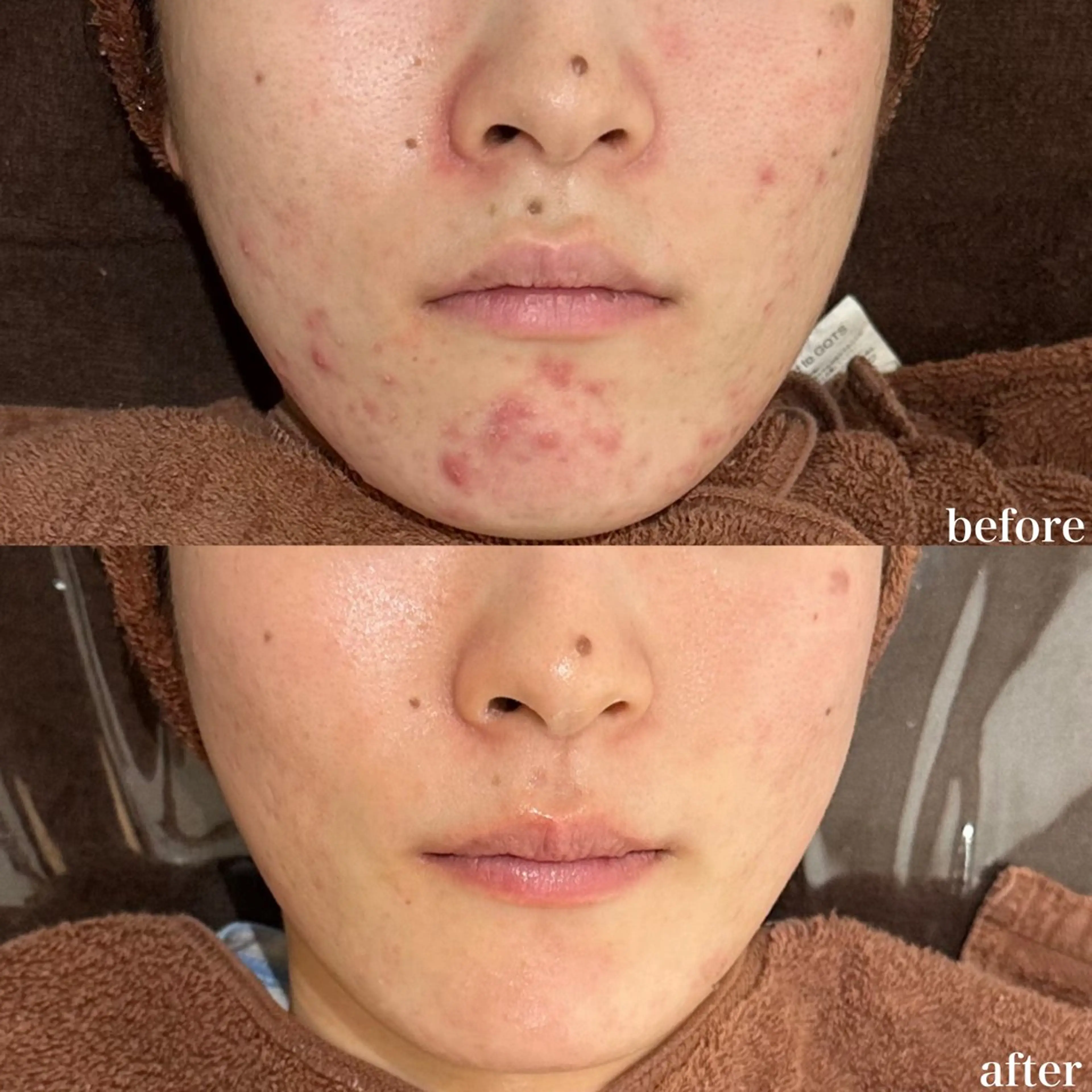 【敏感肌/乾燥肌専用】鎮静&高保湿ミルクピーリング(クリスティーナ)の写真