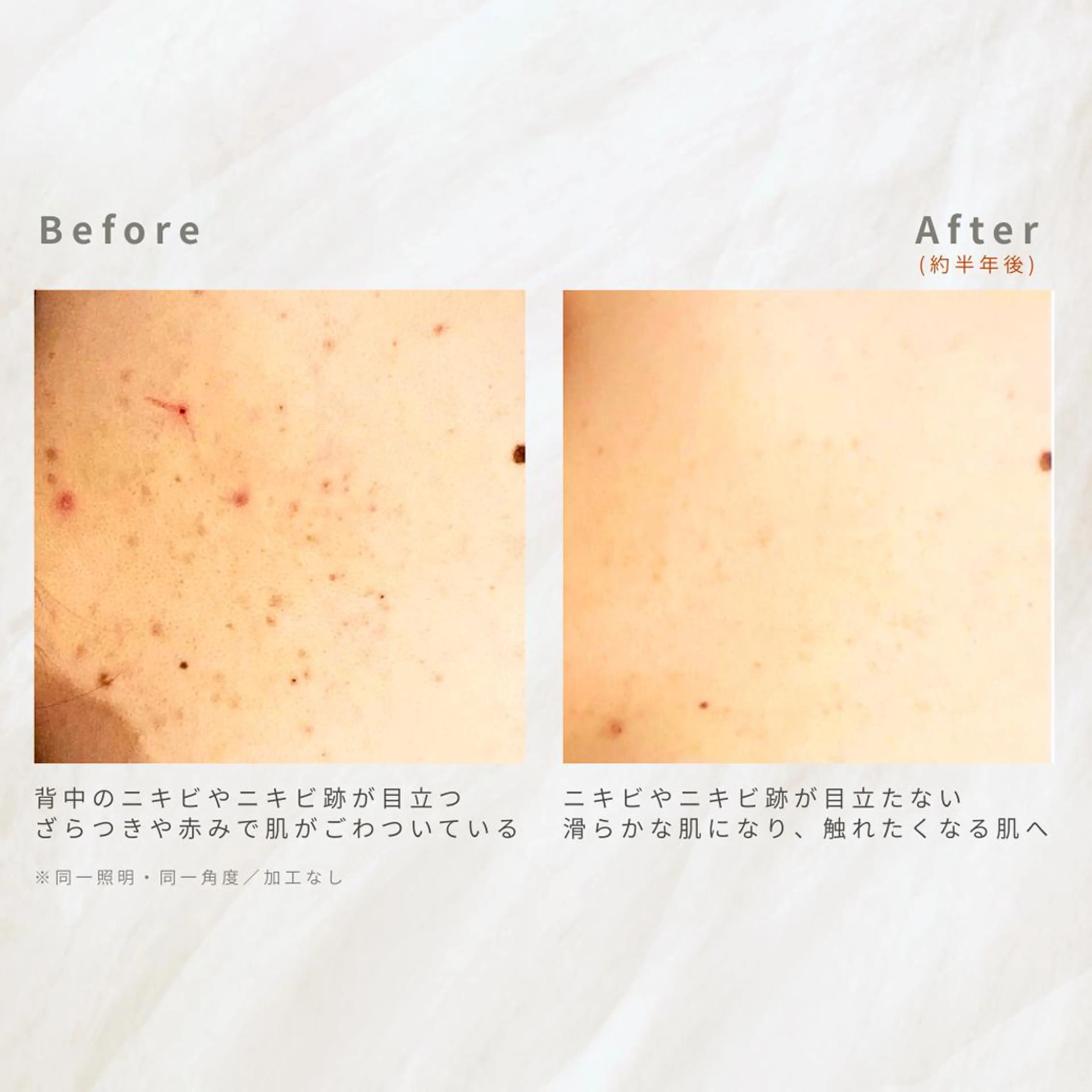 繰り返すニキビを改善 ✨つくば肌質改善専門のエステ・リラクイメージ