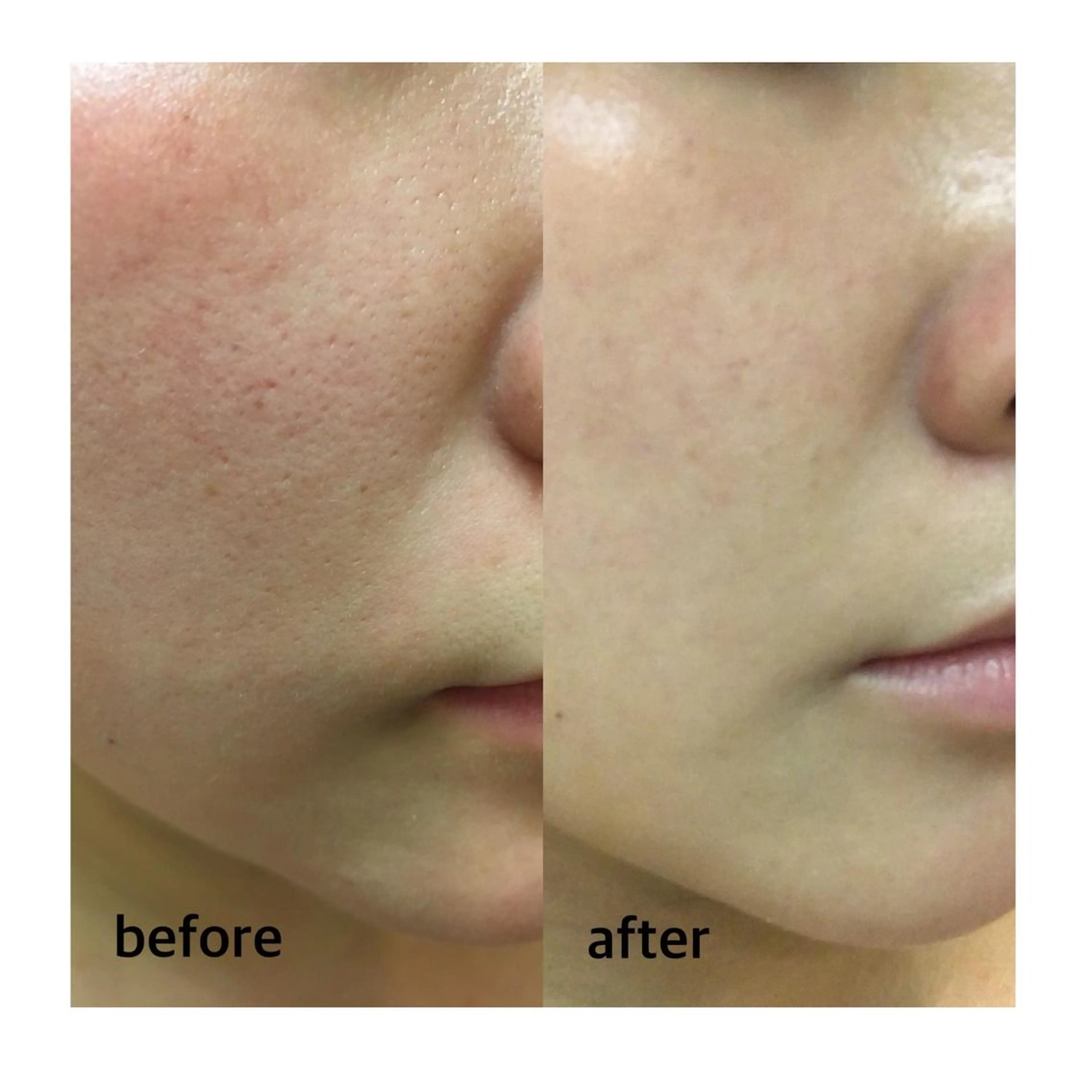 ハーブピーリング/韓国肌管理/フェイシャル/毛穴洗浄/眉毛/顔脱毛【糸脱毛専門】rev所属・ハーブピーリング🌹 毛穴洗浄❤️眉waxのエステ・リラクイメージ