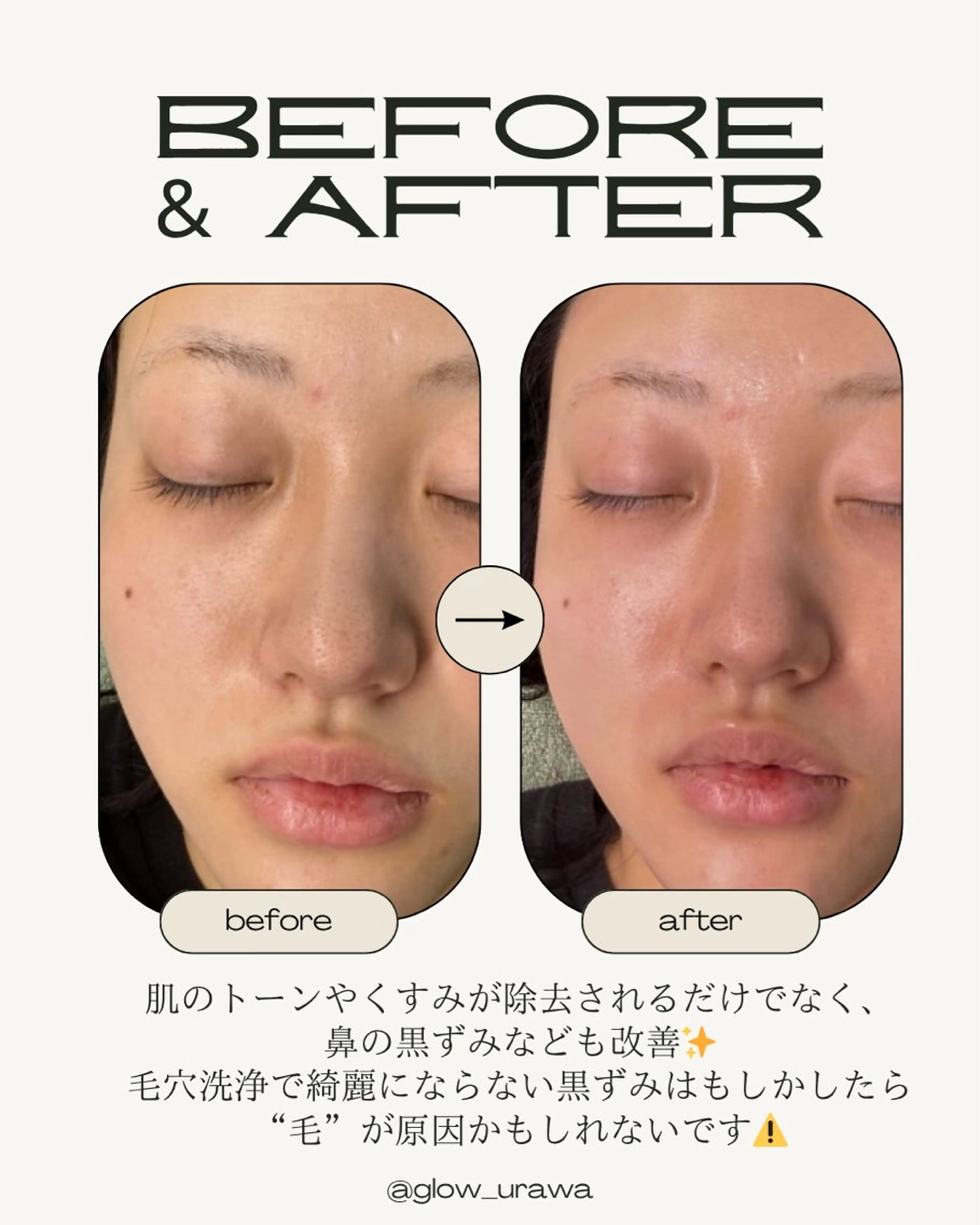 ニキビケア&毛穴改善サロン GLOW所属・GLOW フェイシャルサロンのエステ・リラクイメージ