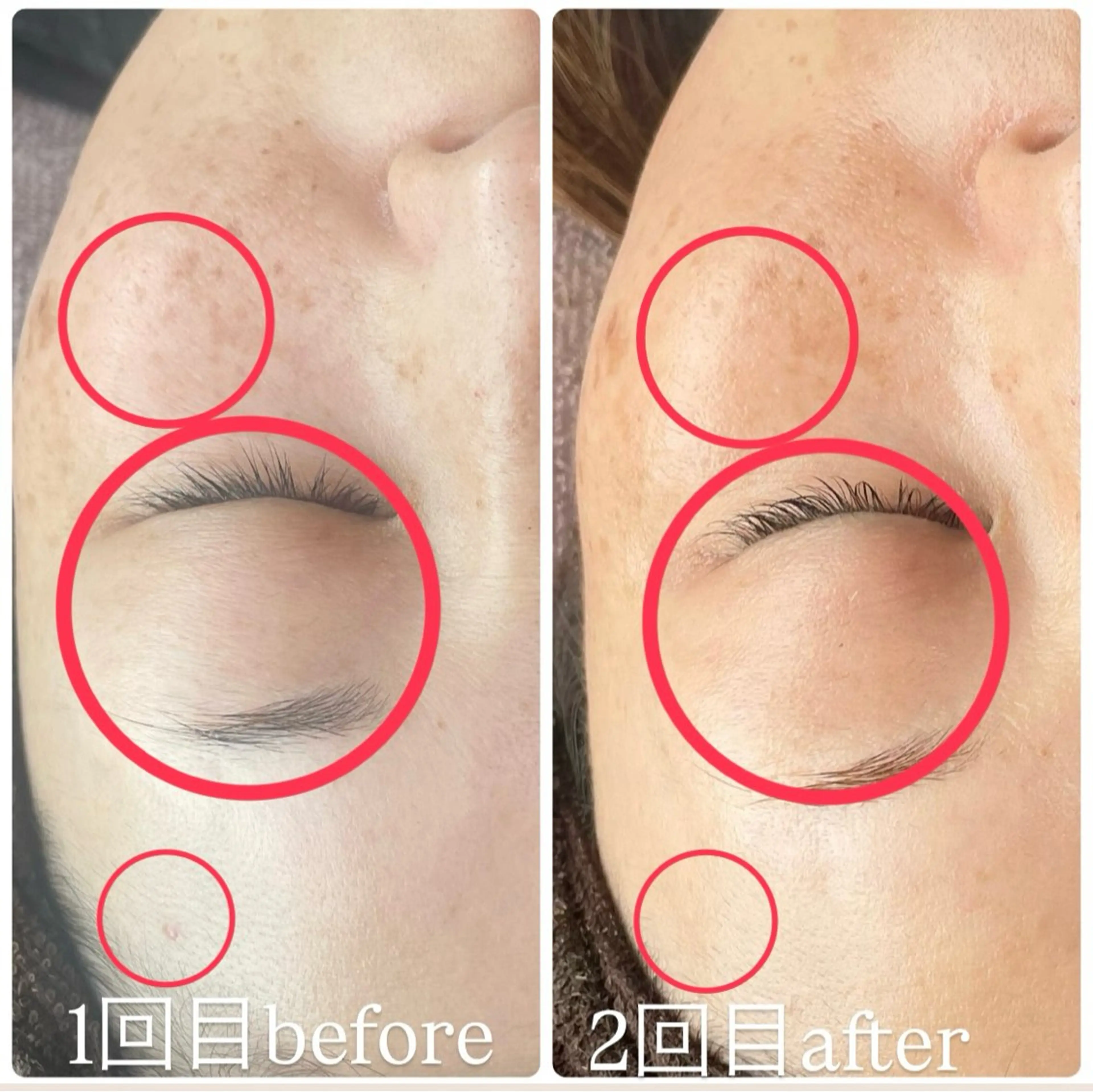 ハーブピーリング【シミ、しわ、たるみ】の写真