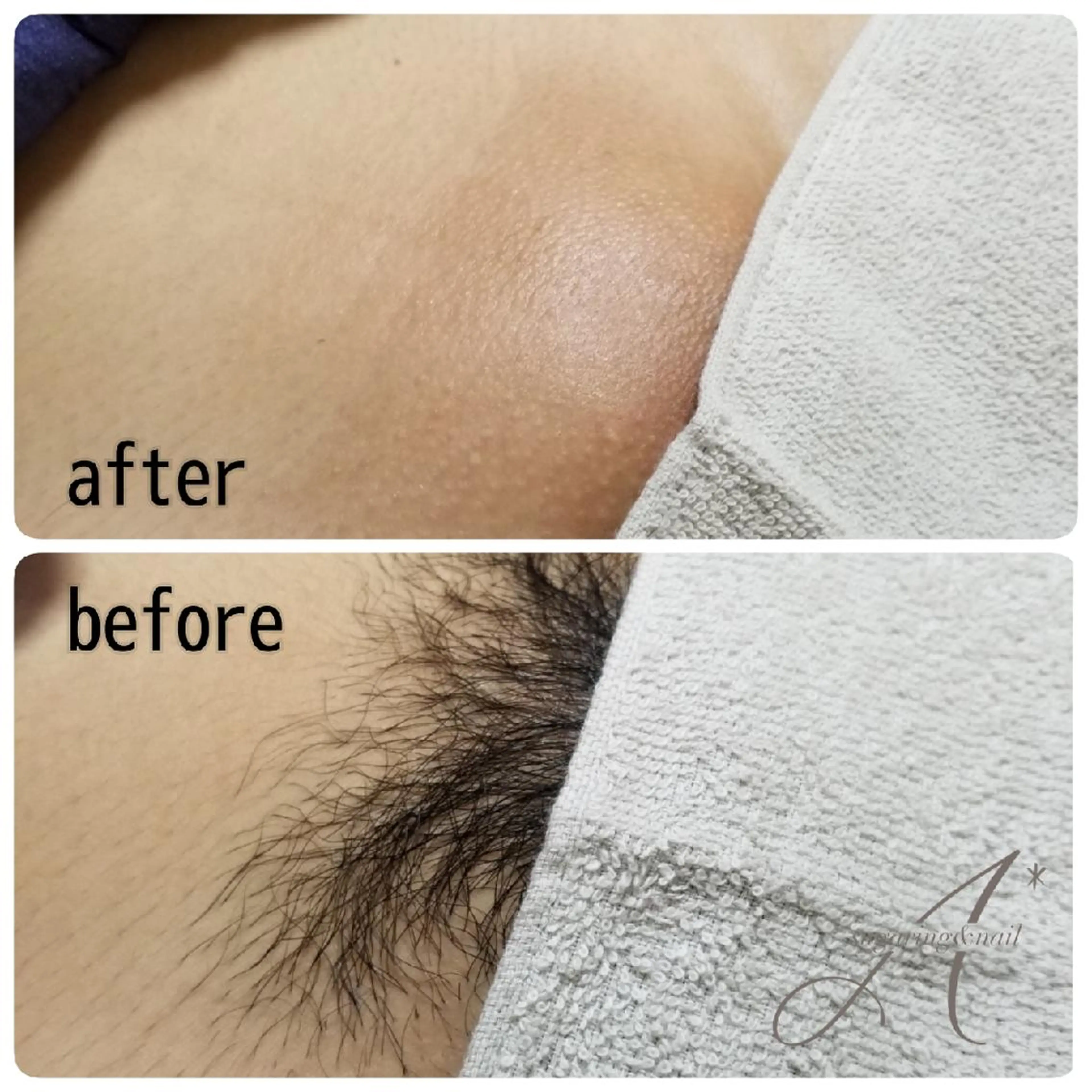 A*[エースター] シュガーリング🍋のエステ・リラクイメージ