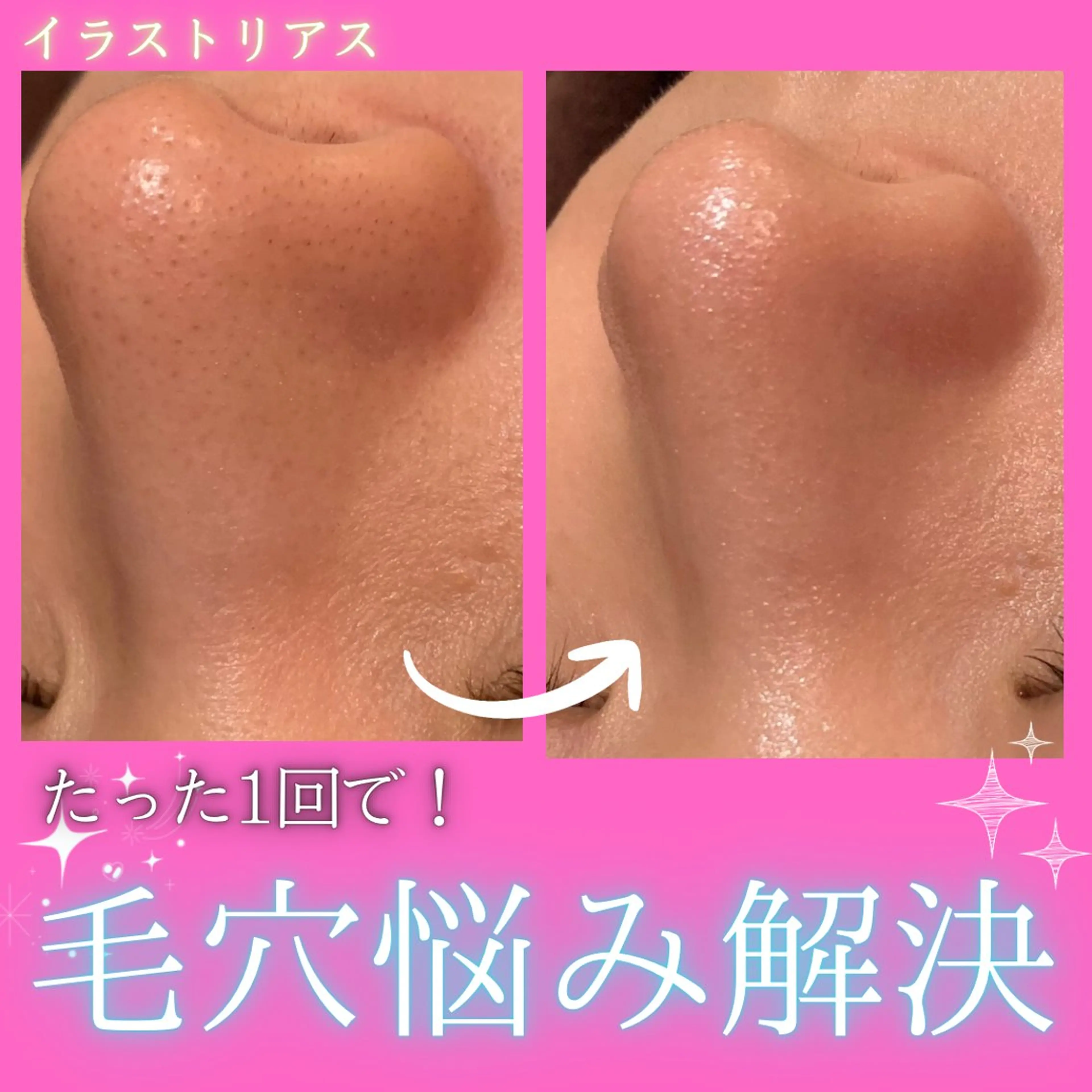 【ハイドロフェイシャル🫧】毛穴の汚れを水流で優しく吸引⚡️透明感をだしてみずみずしい卵肌へと導く💎の写真