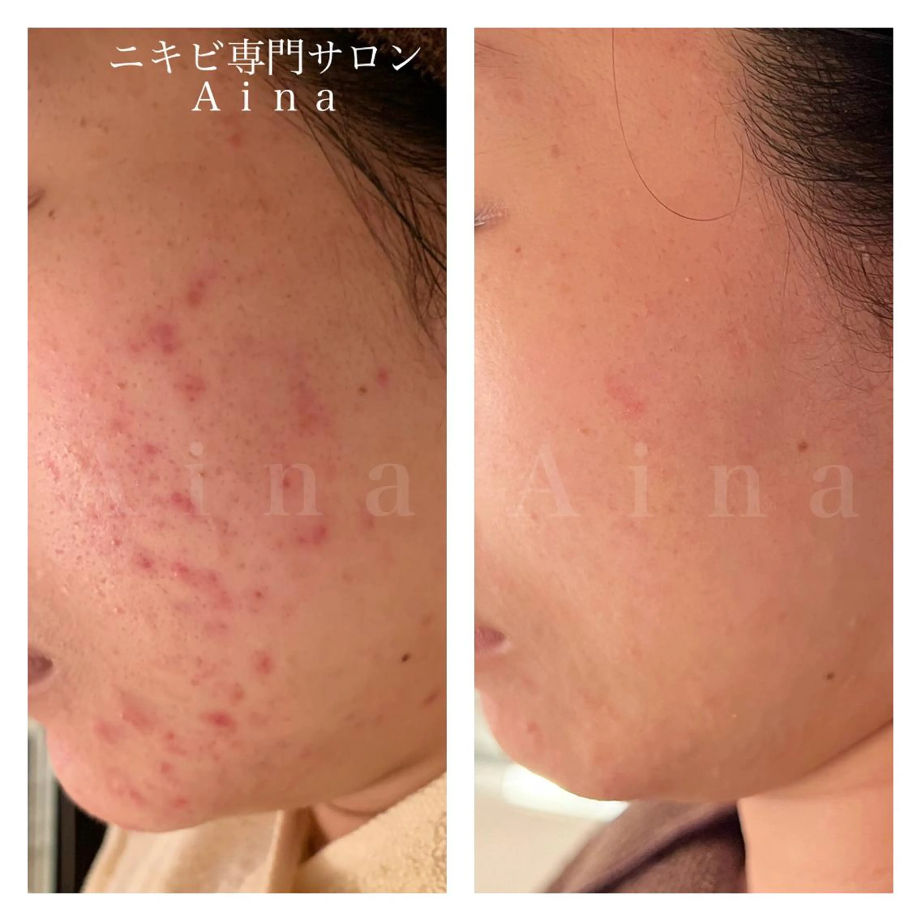 セミロング パーマ ヘアアレンジ メンズ キッズ ネイル マツエク・マツパ アイブロウ エステ リラク ニキビ跡専門サロン Ainaのエステ・リラクイメージ