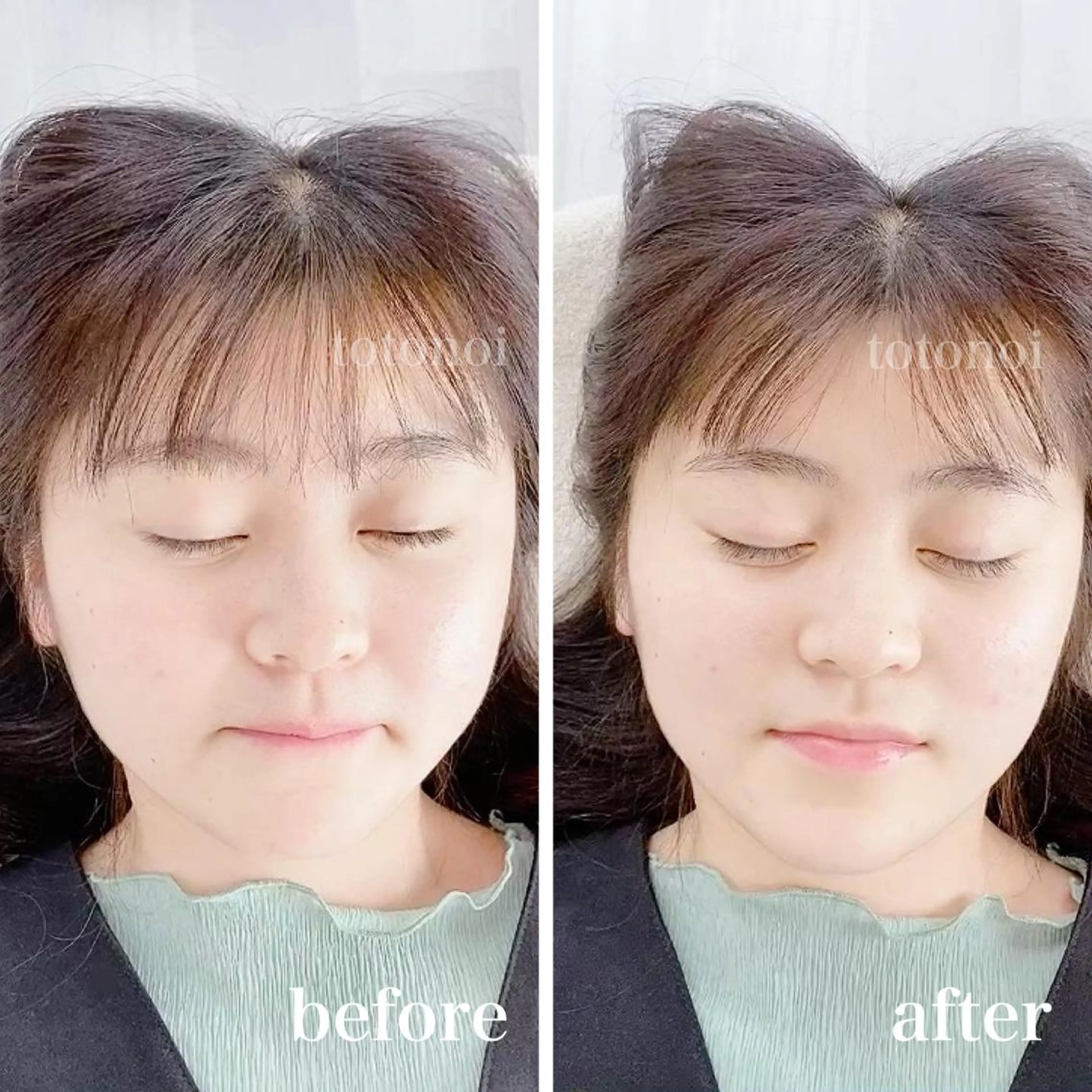 はり灸サロン　totonoi所属・印象の良くなる 美容鍼のエステ・リラクイメージ