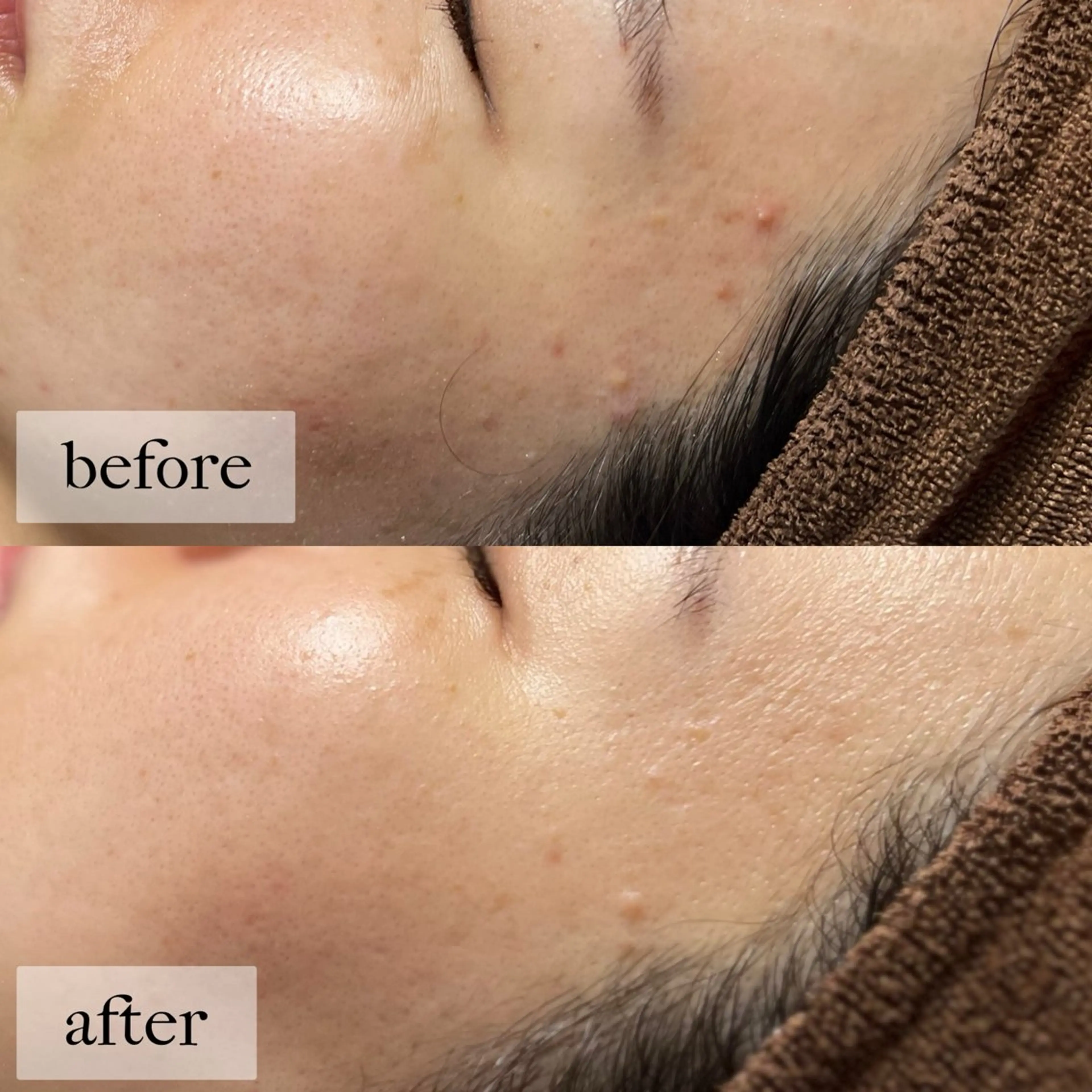 HINANO矢場町店【ヒナノ】所属・脱毛/肌改善🌿 HINANO 村田のエステ・リラクイメージ