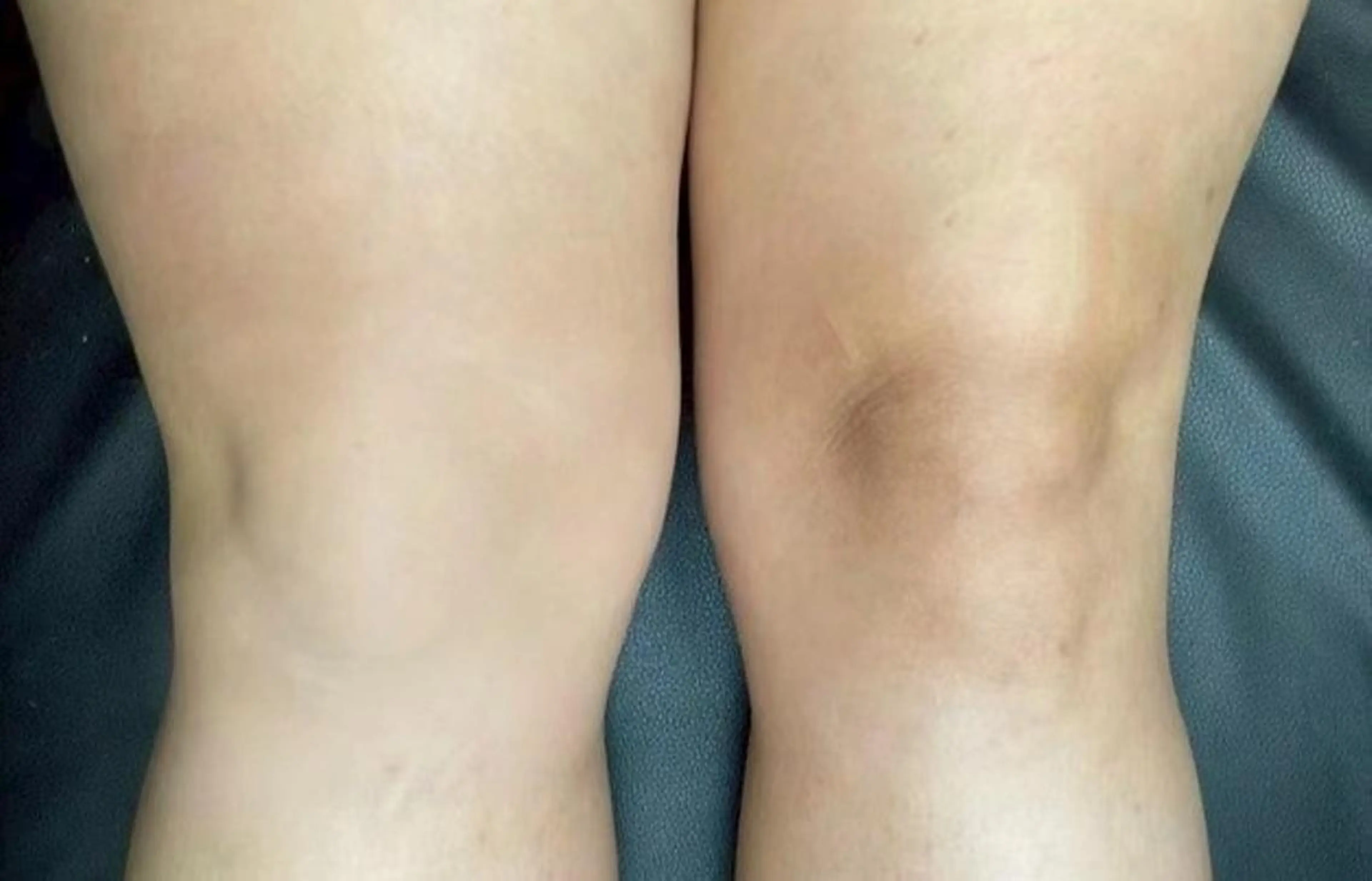 【最先端韓国式メラニンケア】ドールピンク《膝》￥33,000の写真