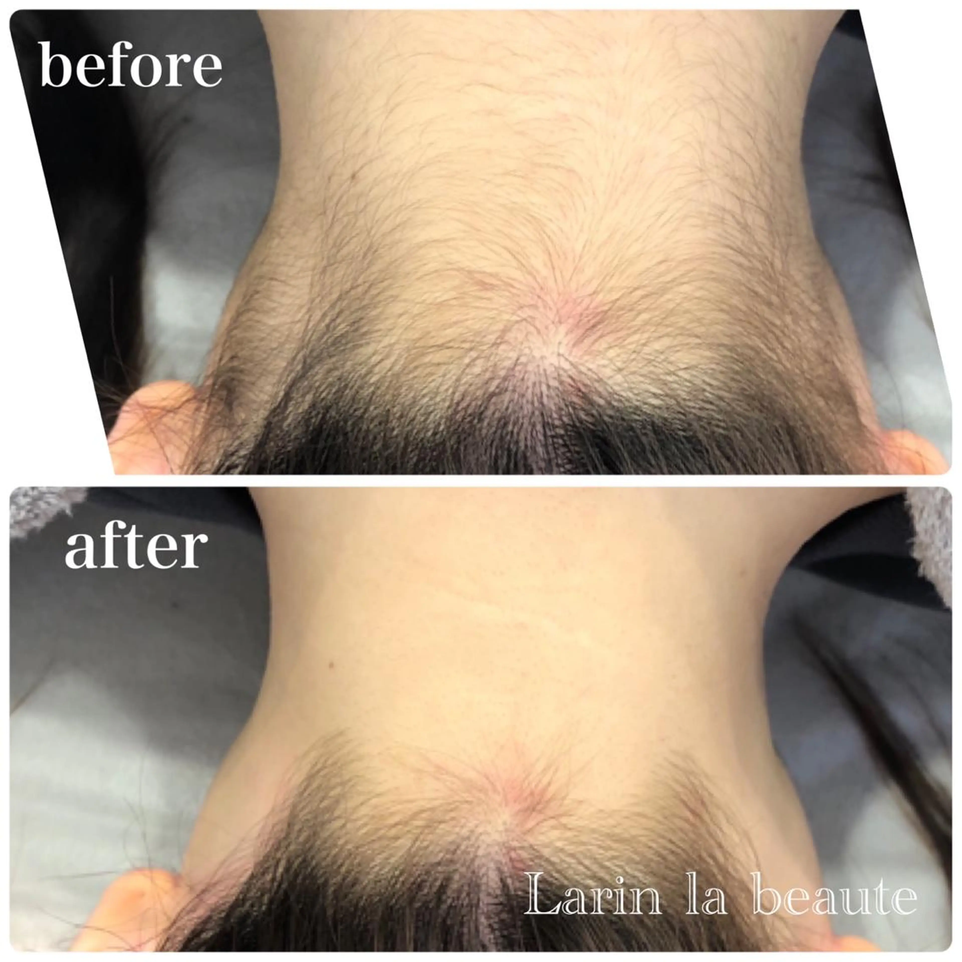 脱毛 美肌脱毛・ハーブピーリング専門店Larin la beaute所属・Larin la beauteのエステ・リラクイメージ