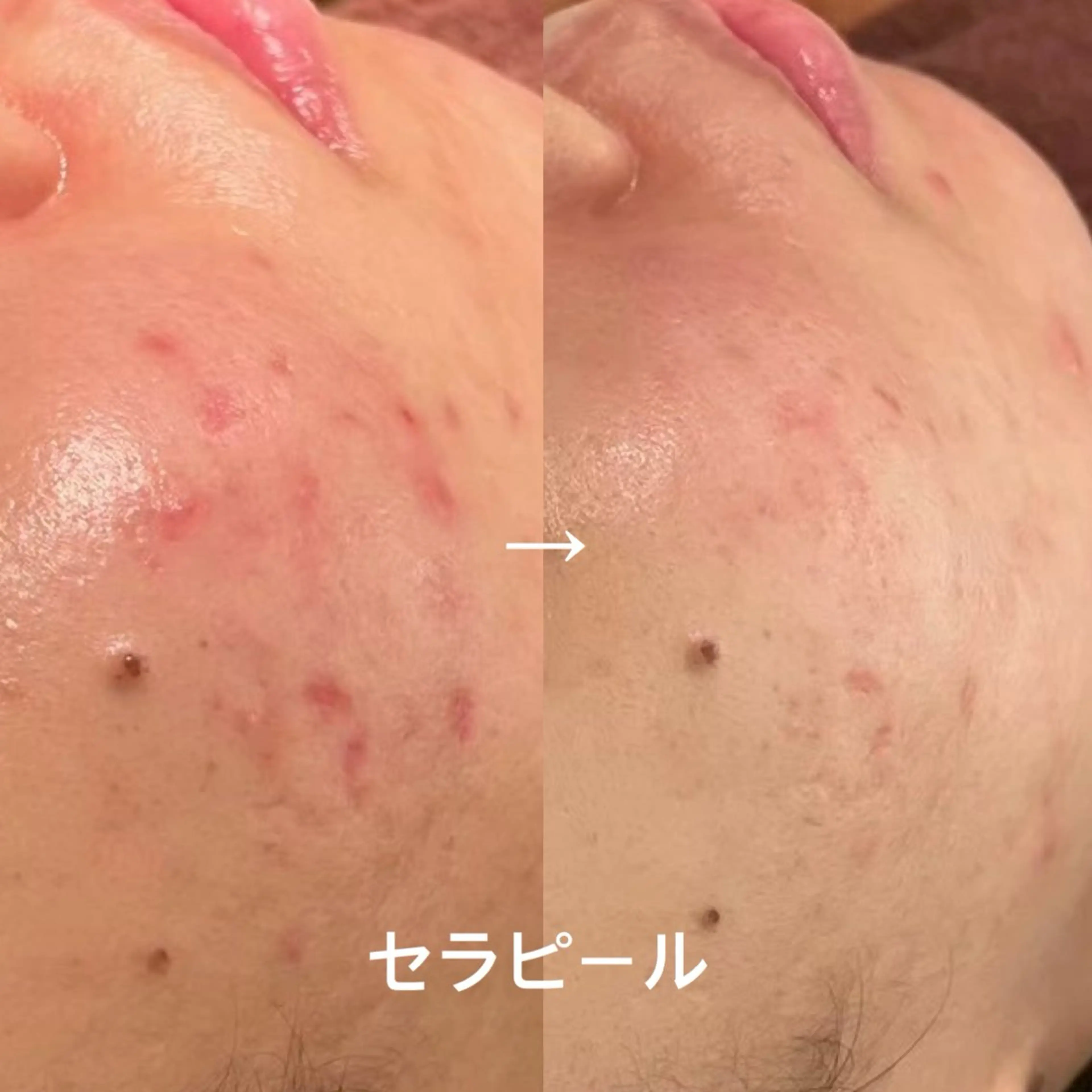 セラピール＋高濃度パック｜赤み・ニキビ跡・ざらつき集中ケアの写真