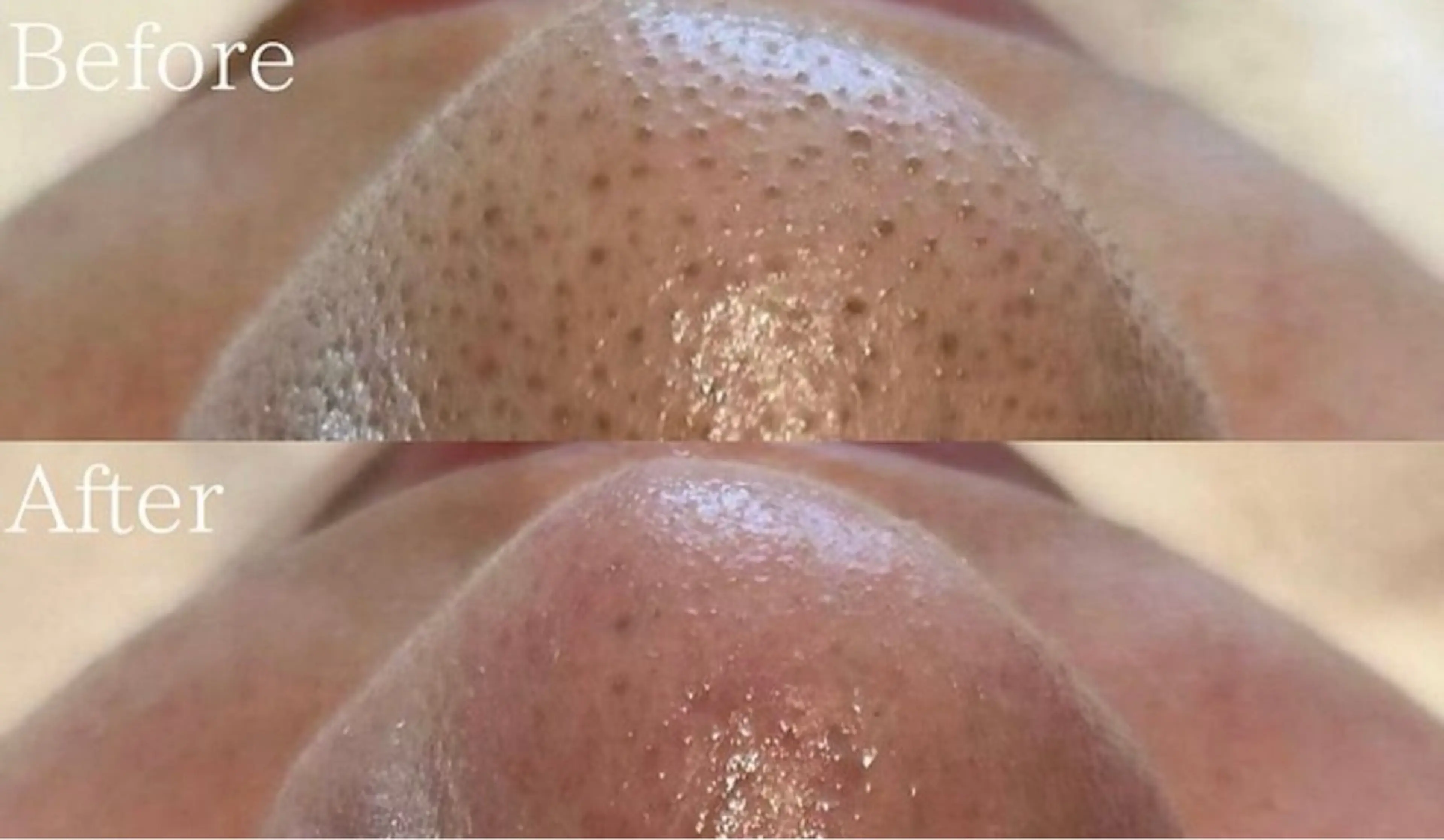 メンズフェイシャルエステ 毛穴開き、よごれ、肌を明るくつやをだしたいかたの写真