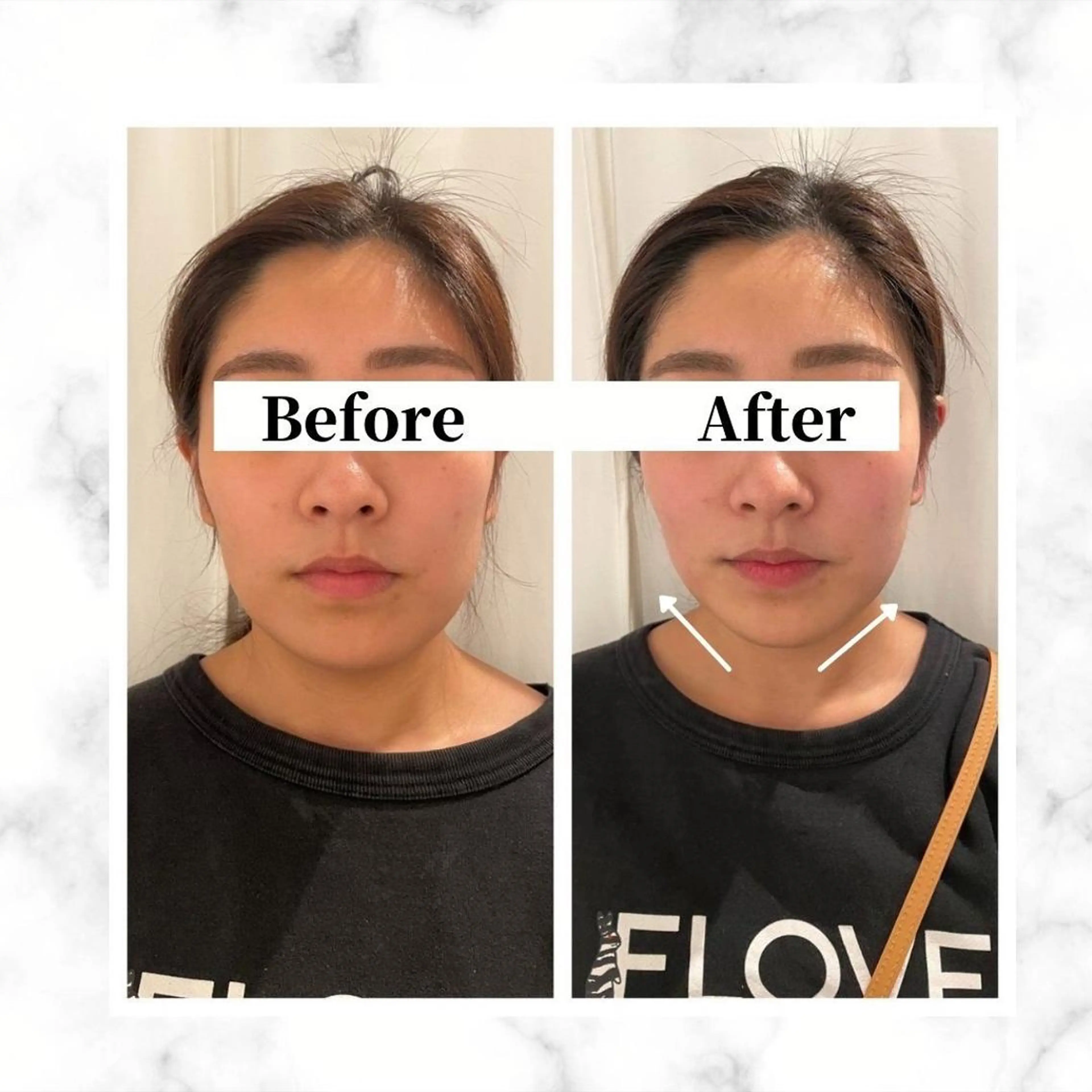 エステ リラク 12Dハイフ💗 最強小顔のエステ・リラクイメージ