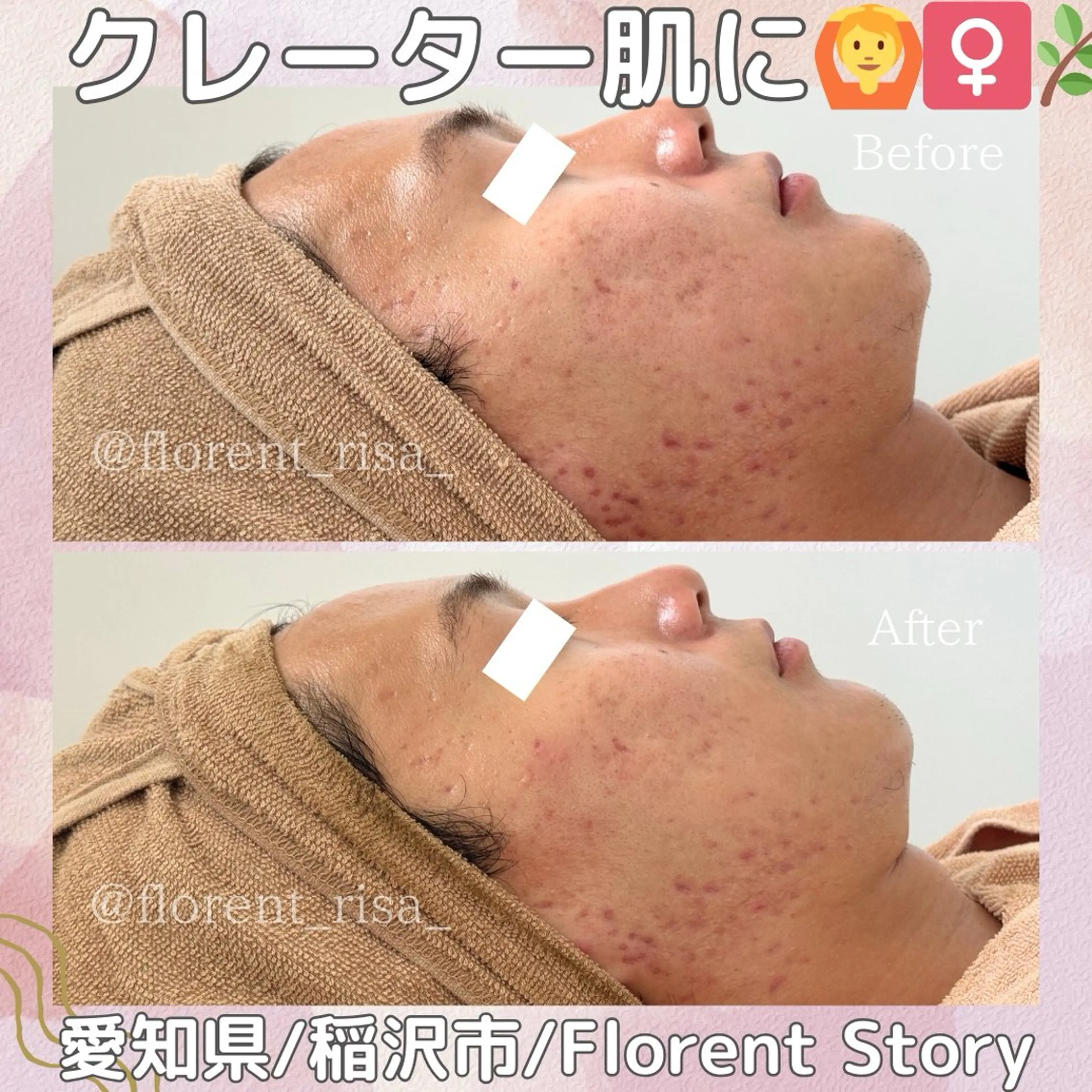 【ミニモ限定】痛みなし!ダウンタイムなし!剥けない次世代ハーブピーリングの写真