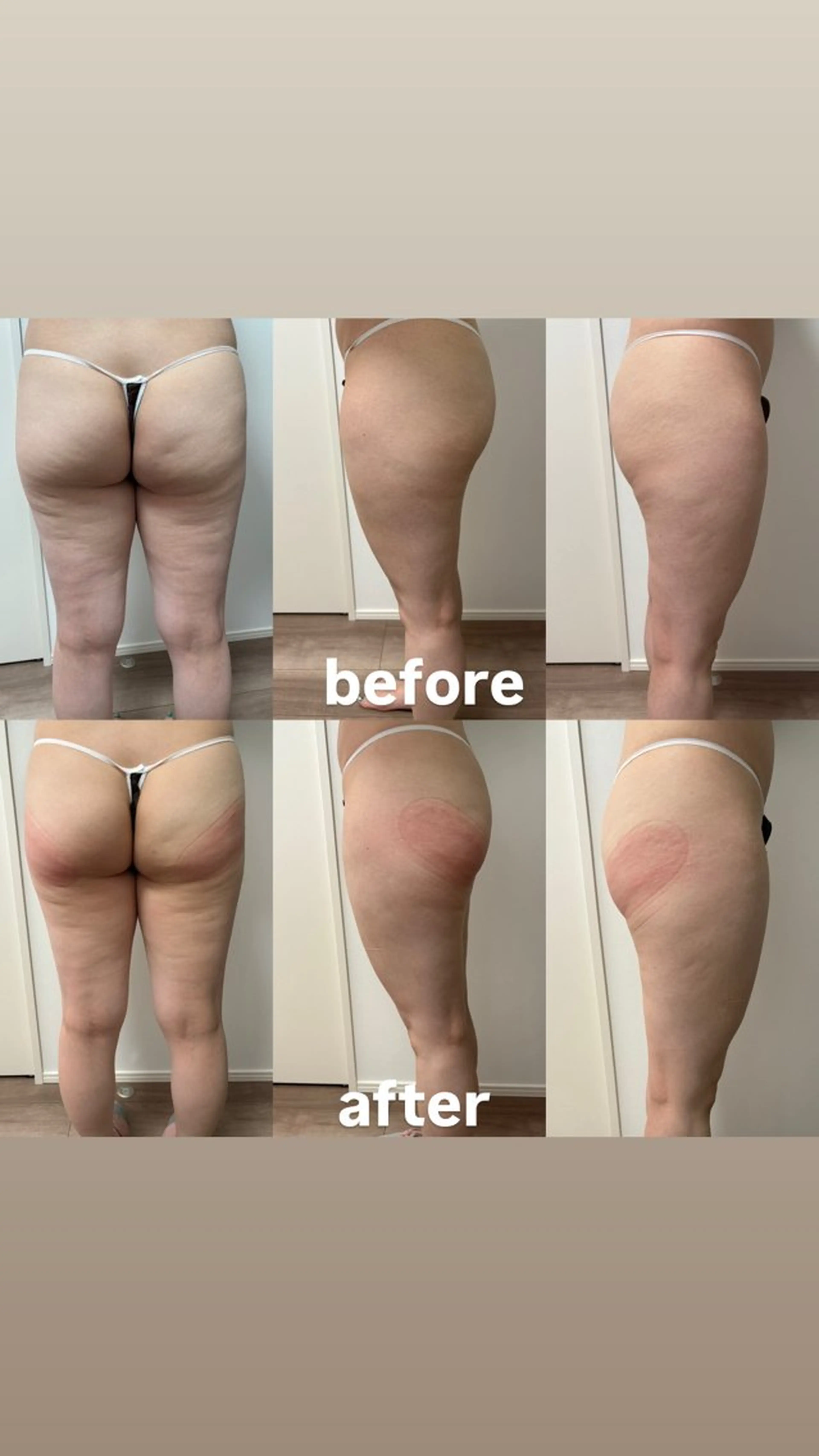 エステ Miiju.所属・Miiju. 石巻市 脂肪冷却  鈴木のエステ・リラクイメージ