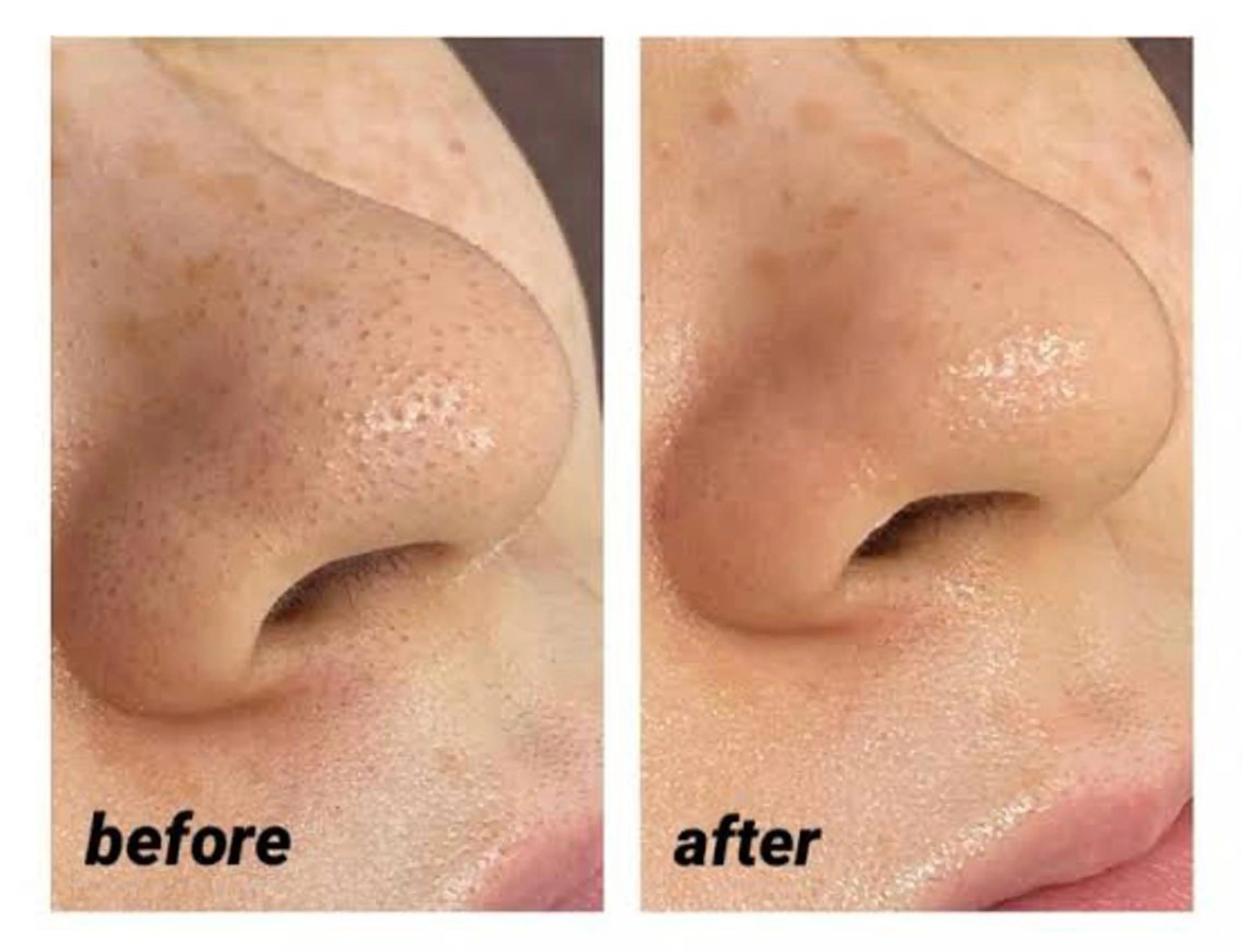 毛穴洗浄(鼻のみ)💖の写真