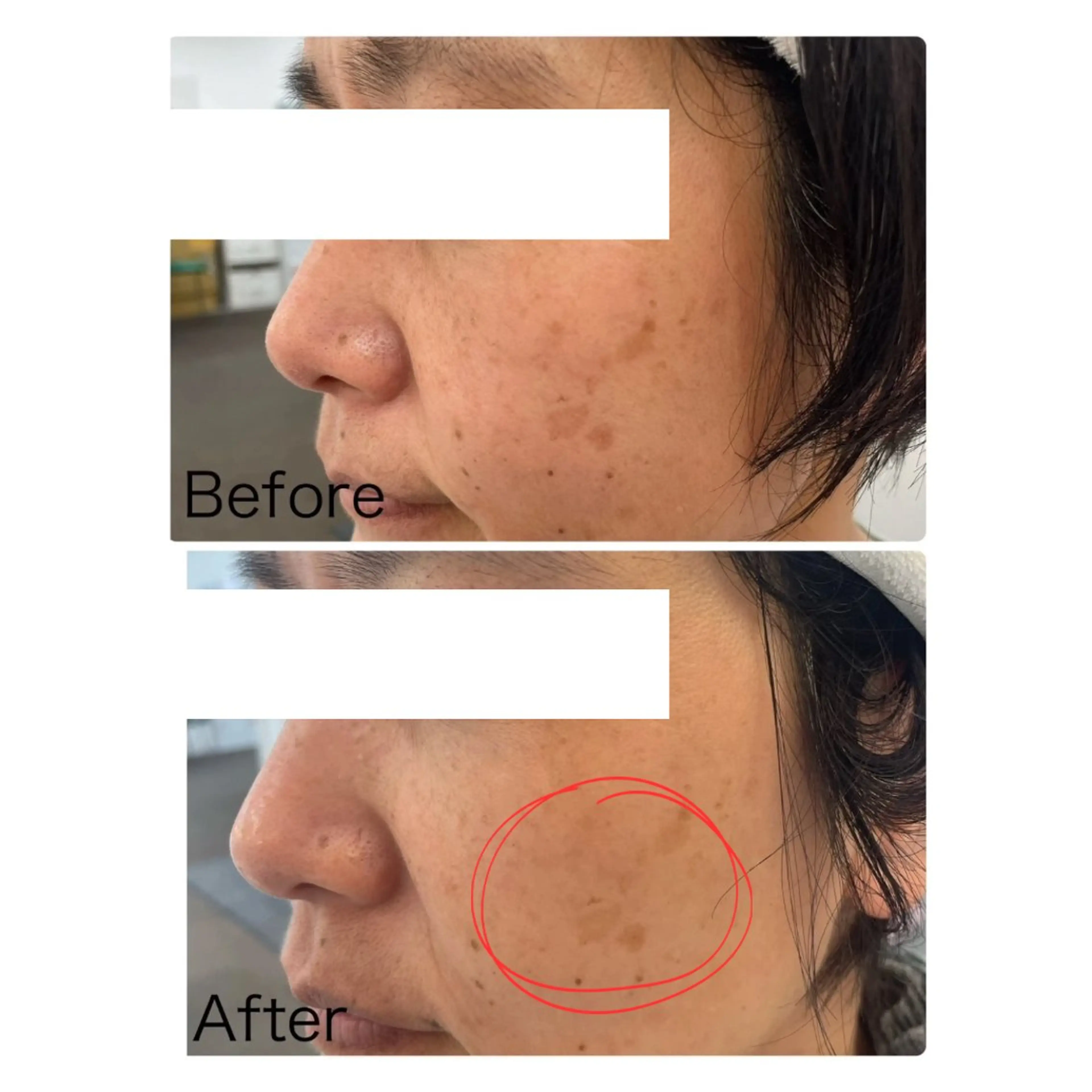 エステ NARIS BEAUTY STATION　デ・アイム あべのルシアス所属・ニキビ跡/毛穴/ 肌質改善/北村ももこのエステ・リラクイメージ