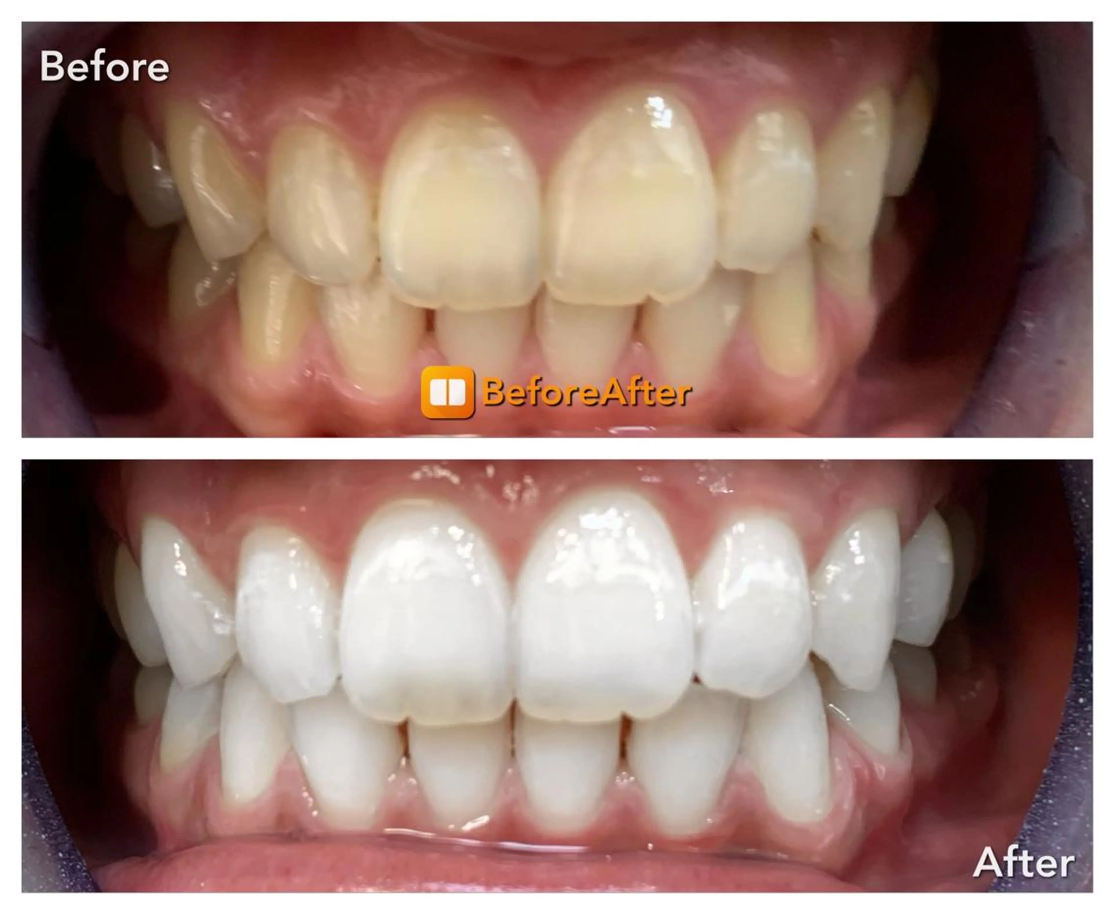 ホワイトニング 8分×2セット×５回券の写真