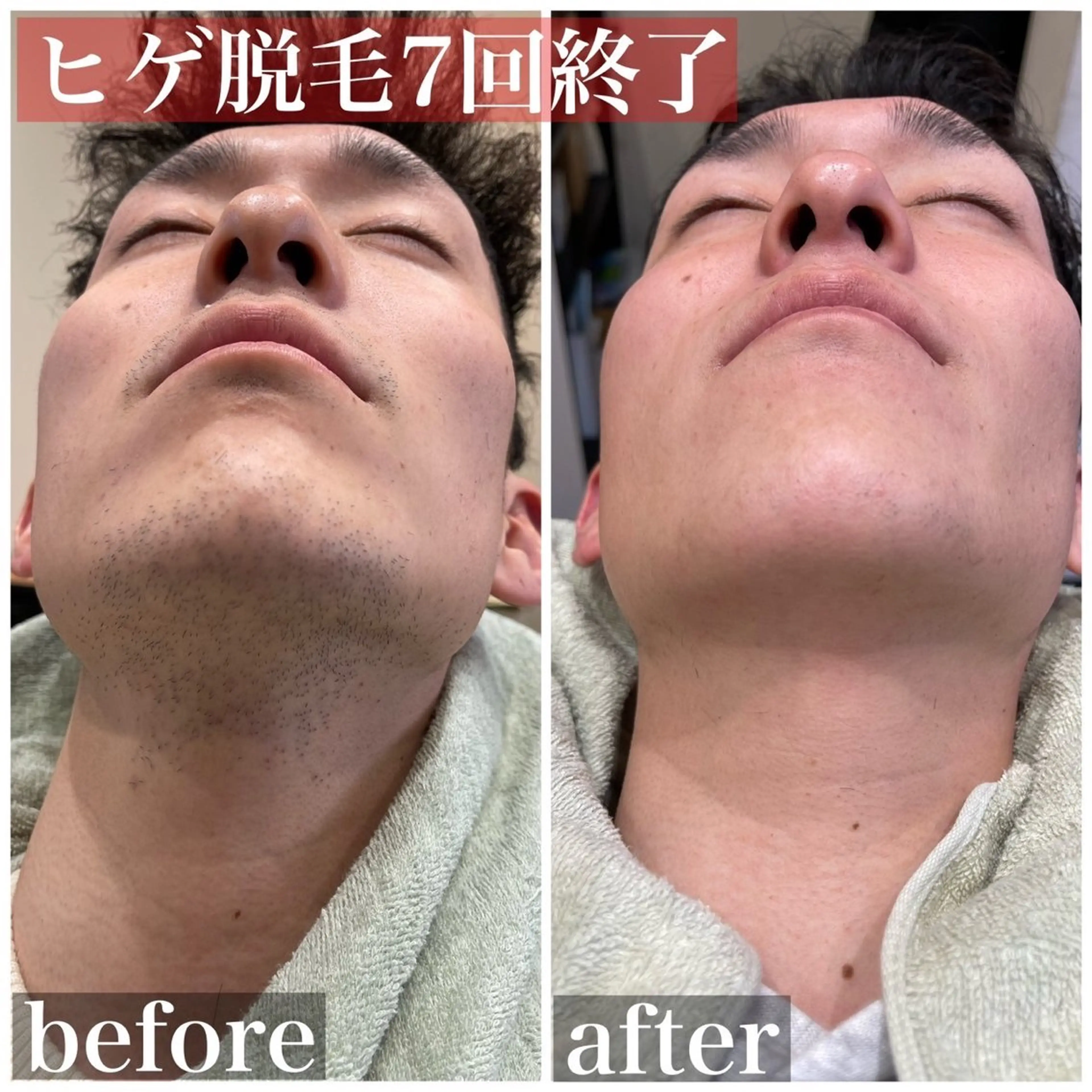 メンズ 脱毛 HAIRS YOSHIOKA所属・ヘアーズヨシオカ MENSヒゲ脱毛のエステ・リラクイメージ