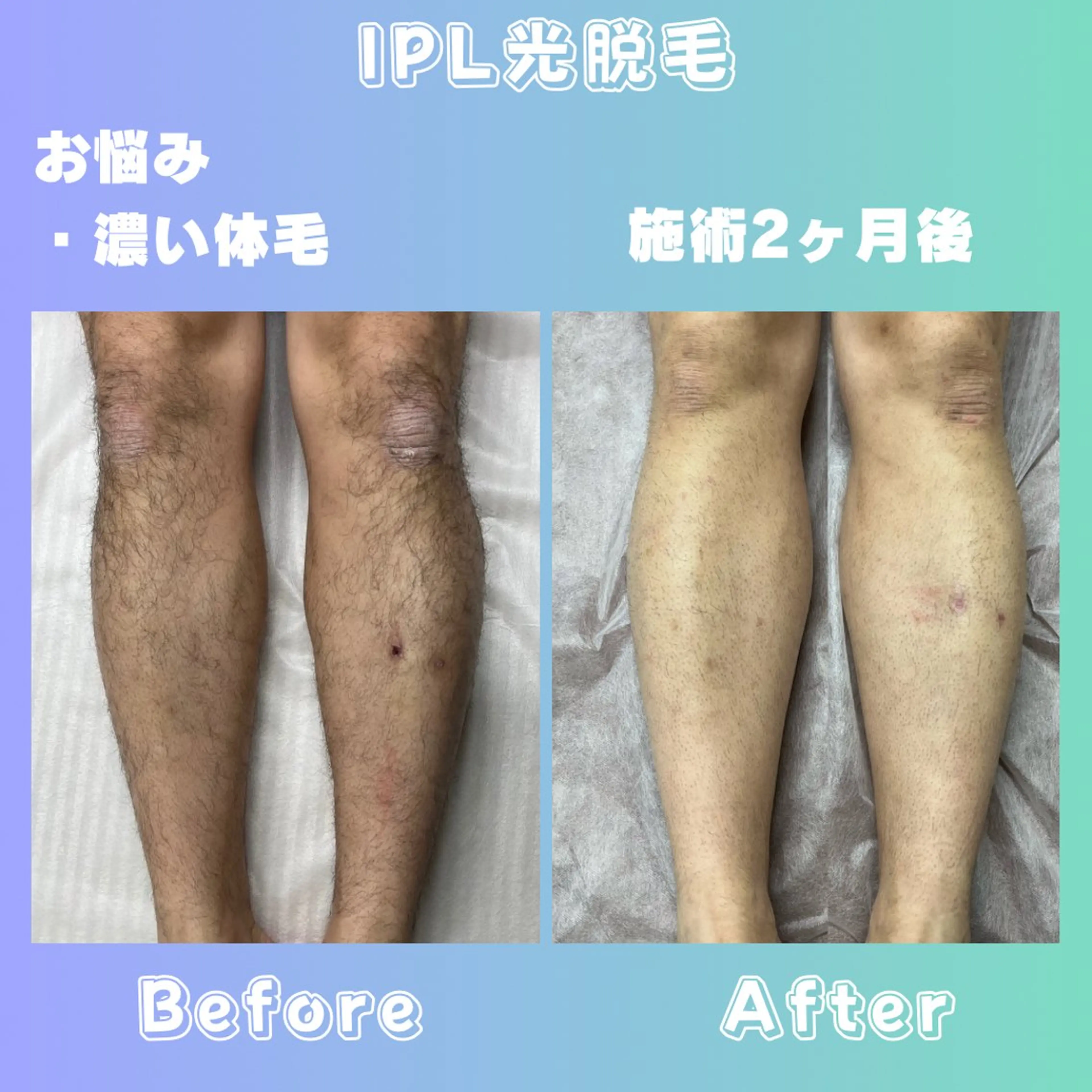 メンズ 脱毛 効果重視脱毛サロンRICE所属・肌質改善/都度脱毛 Mahinaのエステ・リラクイメージ