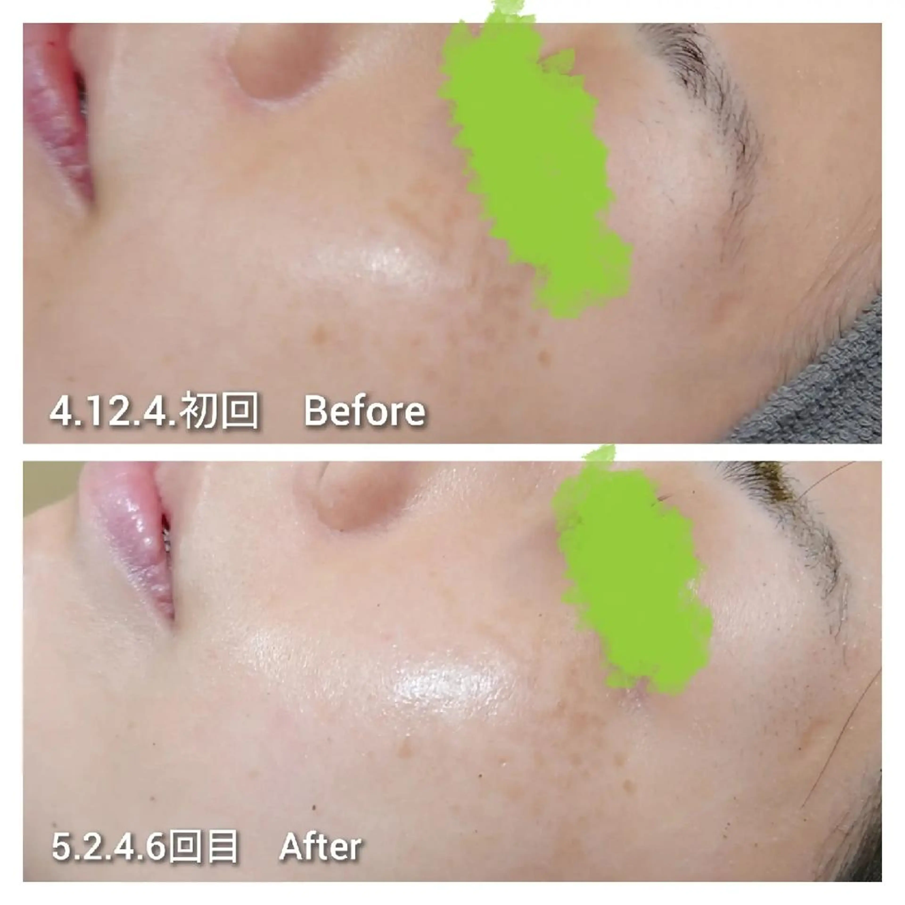 エステ Beauty Salon Luana所属・Luanaまつパ脱毛 ハーブピーリング眉毛のマツエク・マツパデザイン