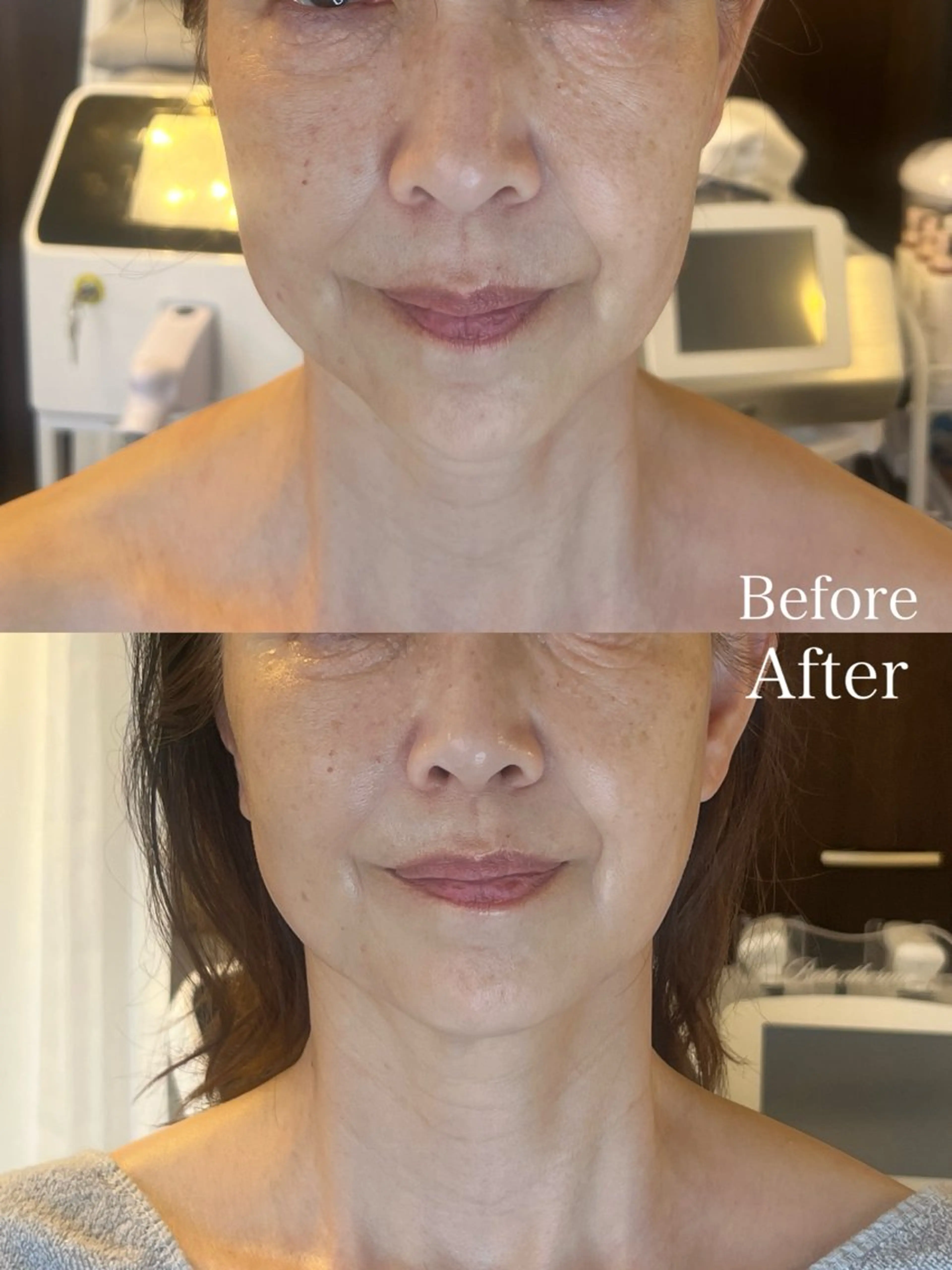 たるみ、ほうれい線に悩む方へ！人気No.1フルコース通常44,000円→8,800円　贅沢9行程⭐︎  症例モニター価格の写真