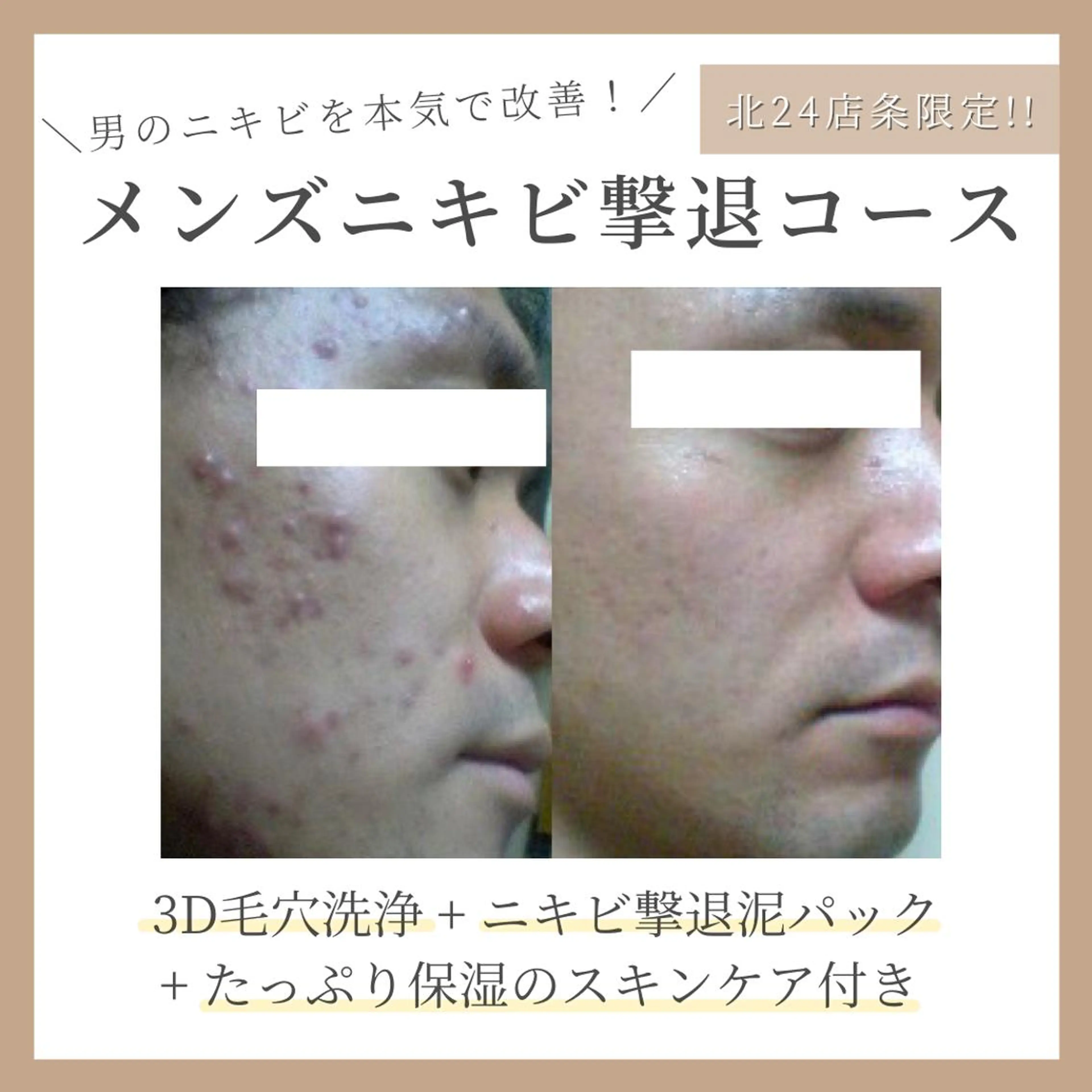 メンズニキビ撃退コース 約70分（初回カウンセリング＋3D毛穴洗浄＋ニキビ撃退泥パック＋高保湿スキンケア）の写真