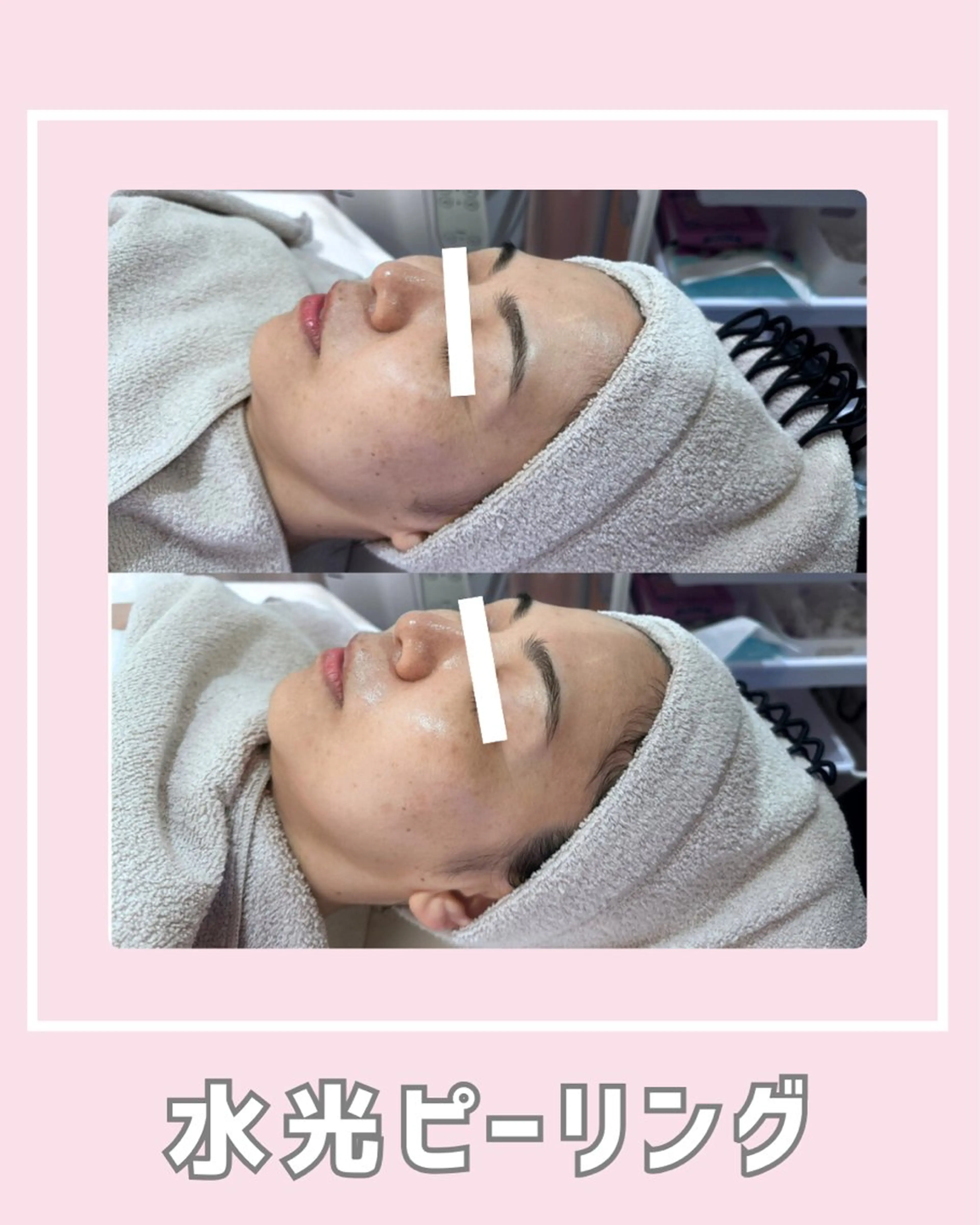 エステ |ピーリング・毛穴| soina神楽坂のエステ・リラクイメージ