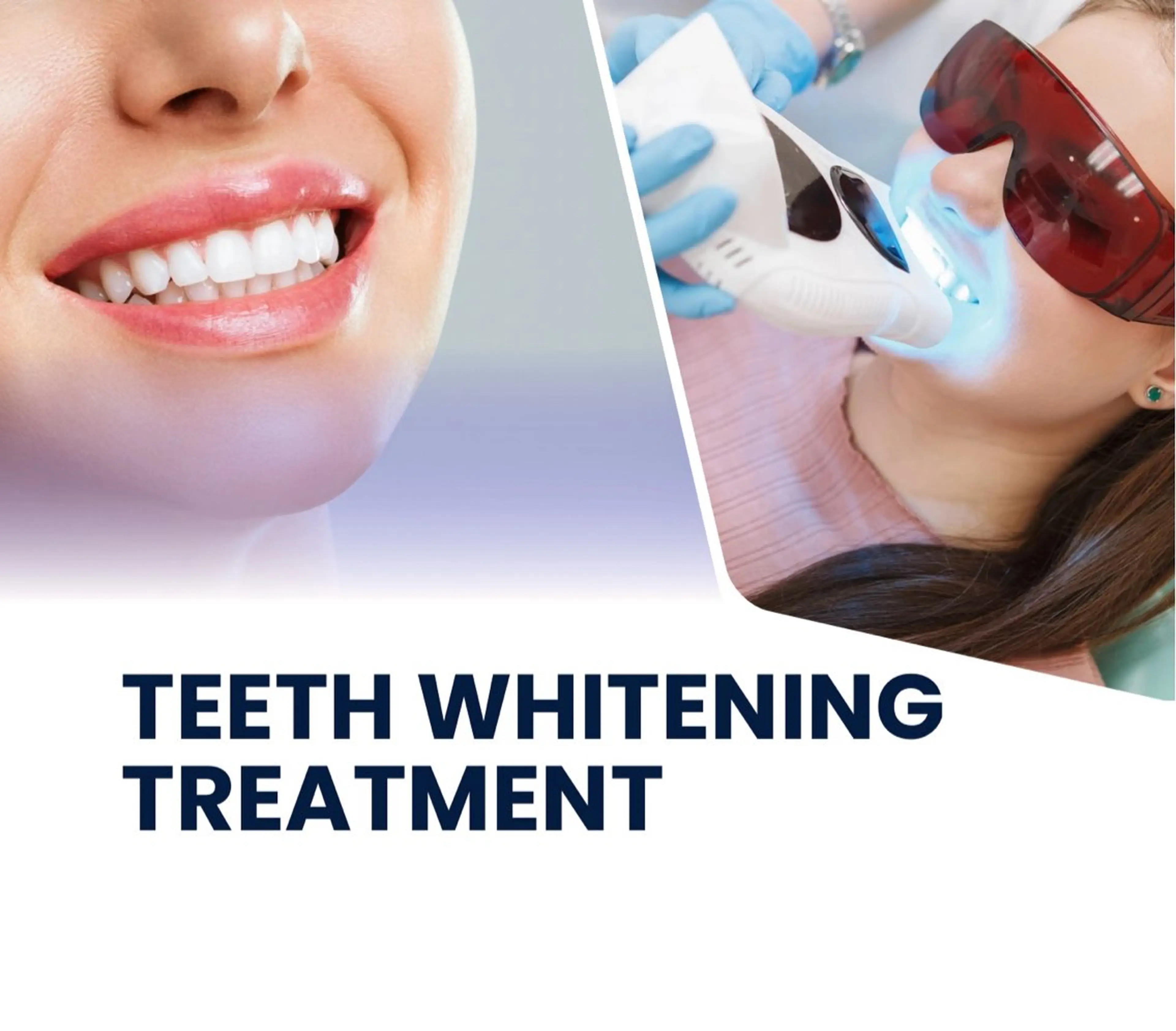 ✨ホワイトニング✨ナチュラルホワイトニング8分×3照射🦷🪥の写真