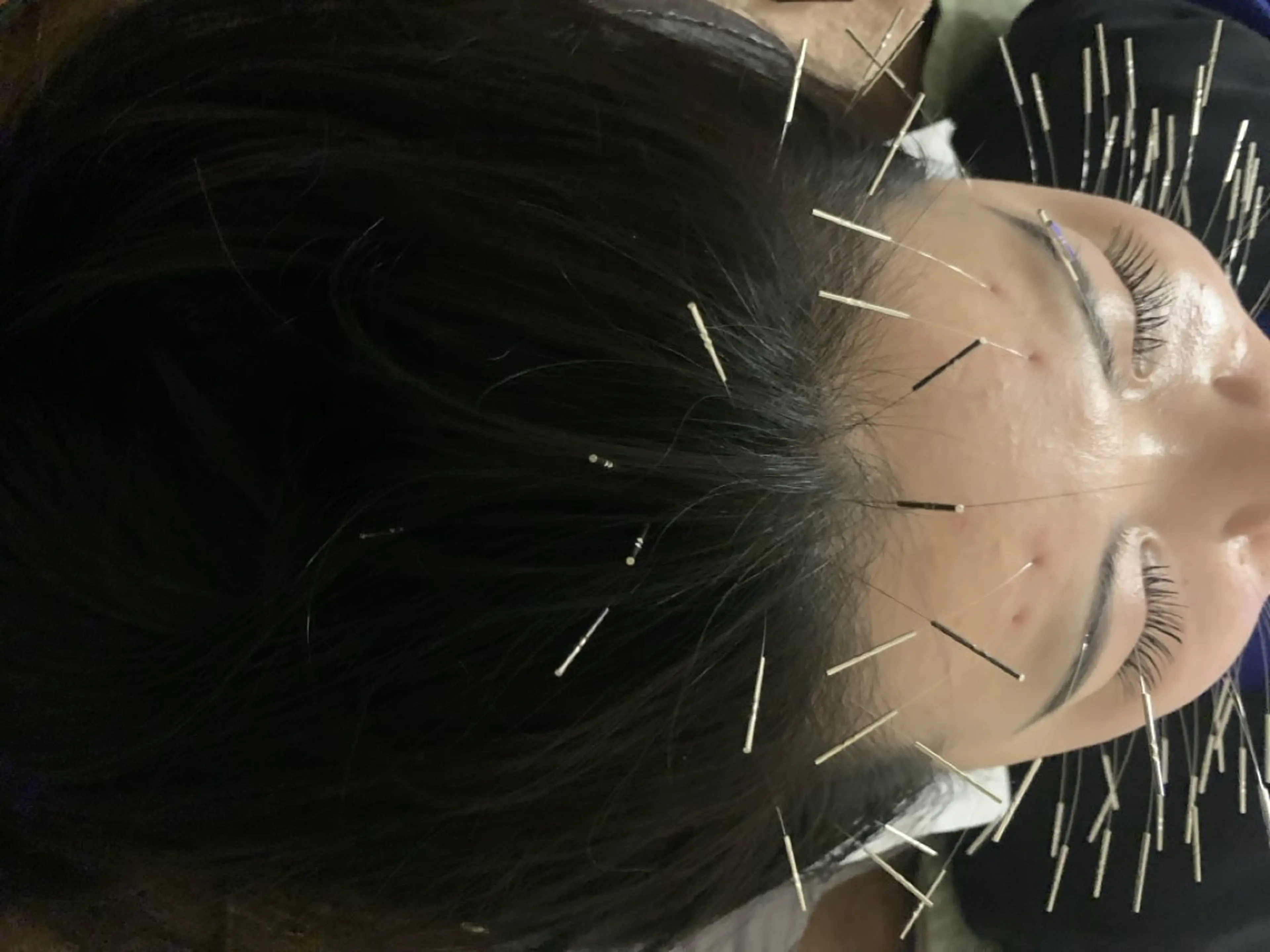 表参道鍼灸院K 美容鍼🔮ララピールのエステ・リラクイメージ