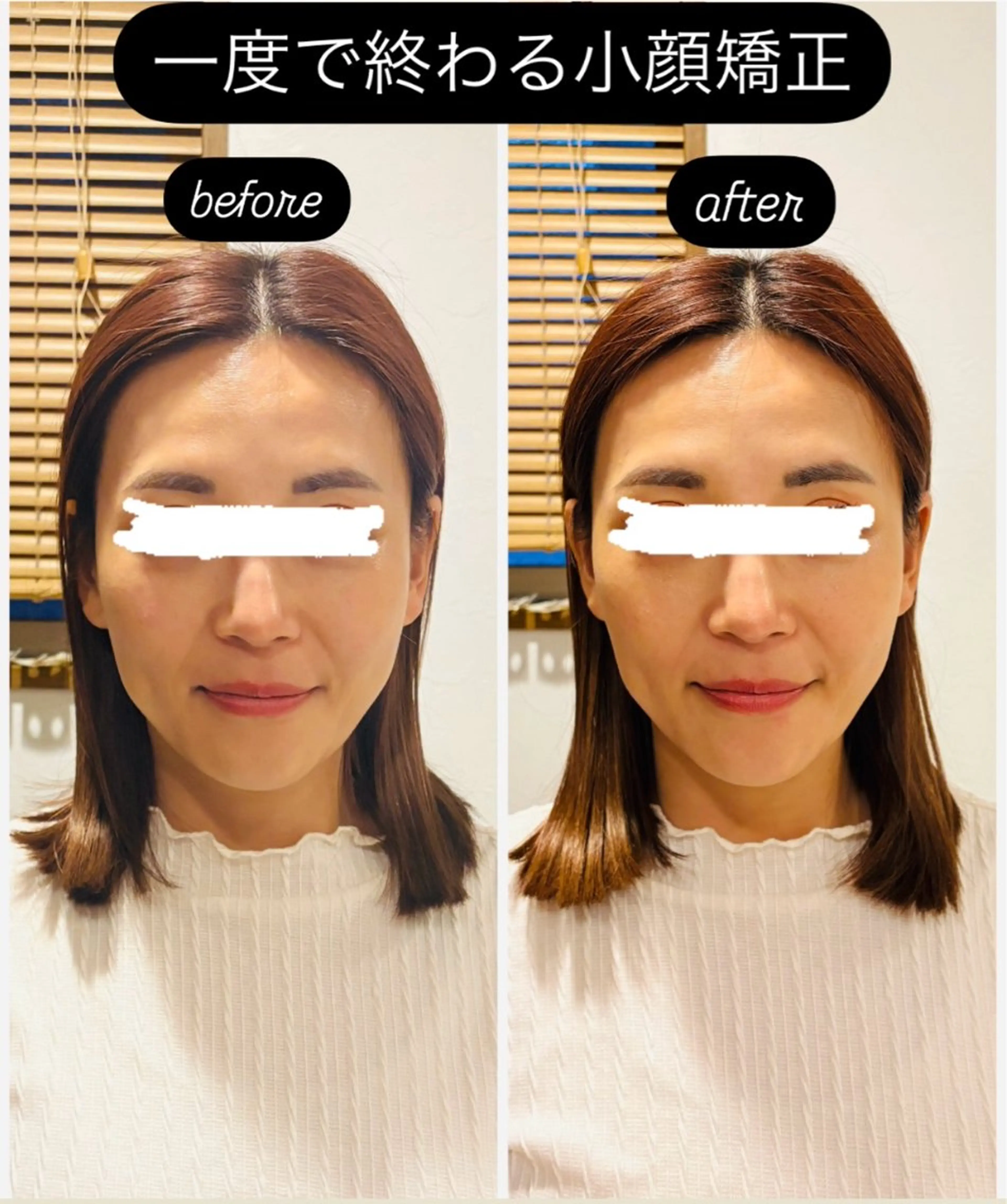 【生涯一度】の小顔矯正【全顔】￥56000⇒￥32000の写真