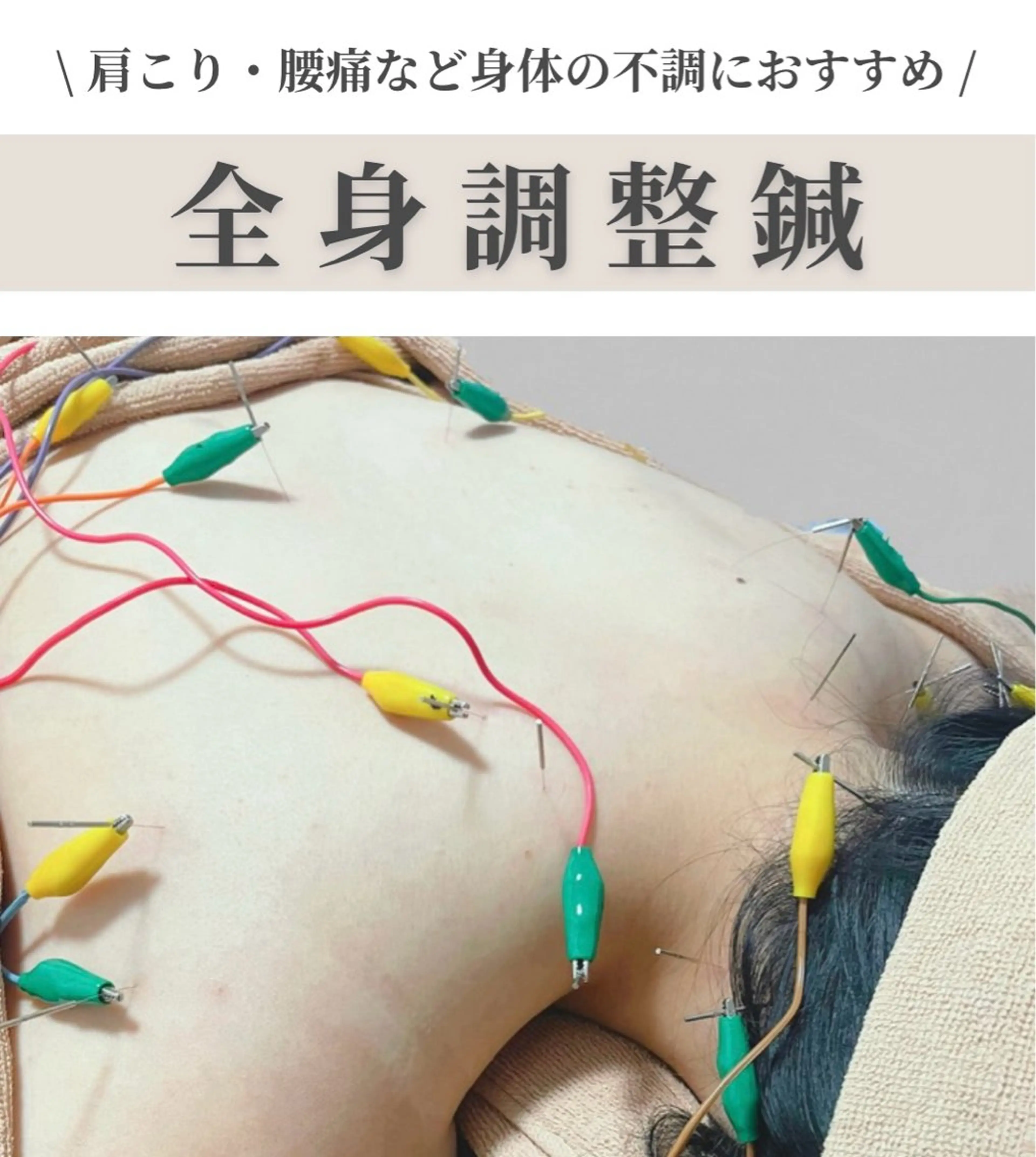 【ご新規様限定】全身調整鍼《肩こり・頭痛でお悩みの方へ》の写真