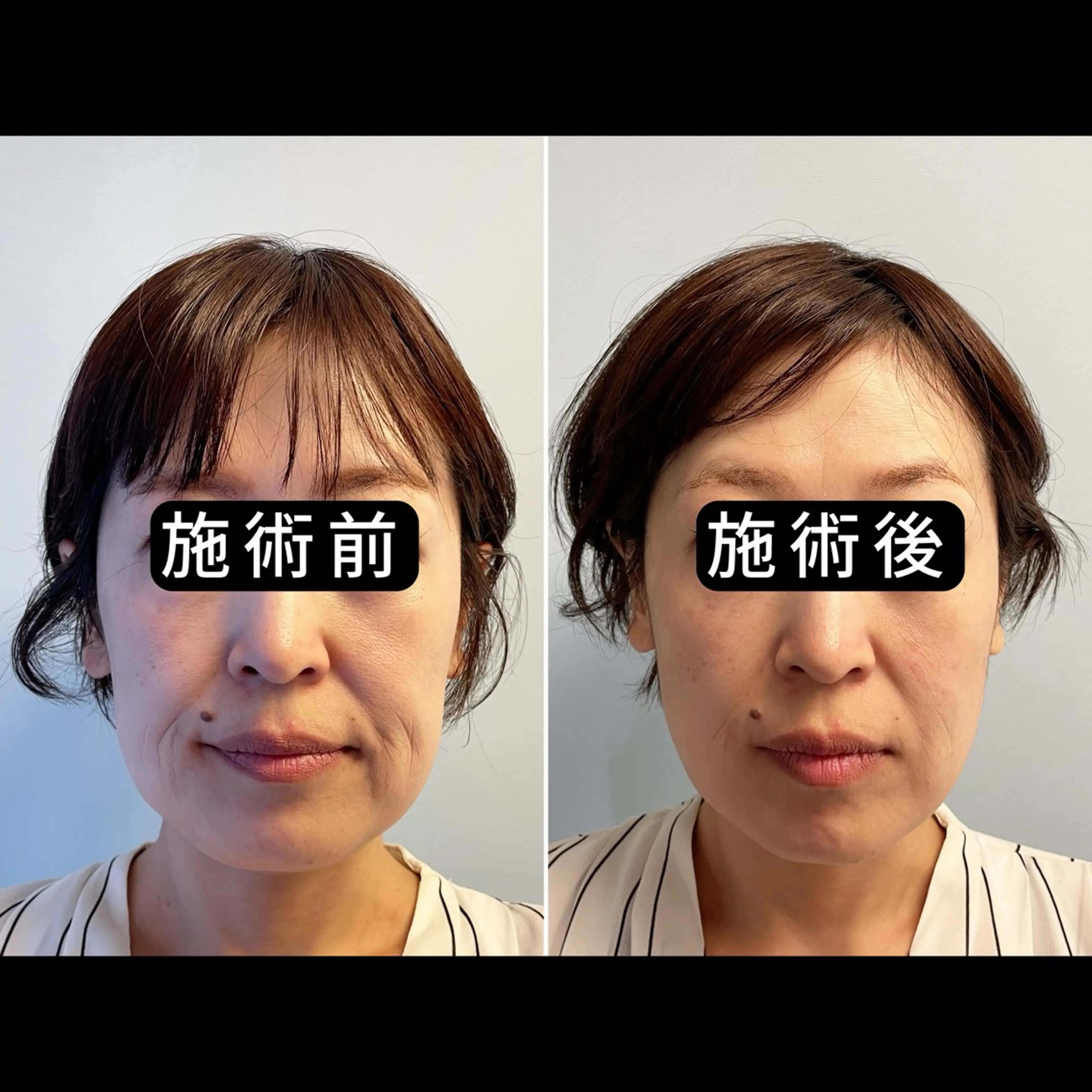 エステ リラク 渋谷 小顔美容鍼 専門サロン YZのエステ・リラクイメージ