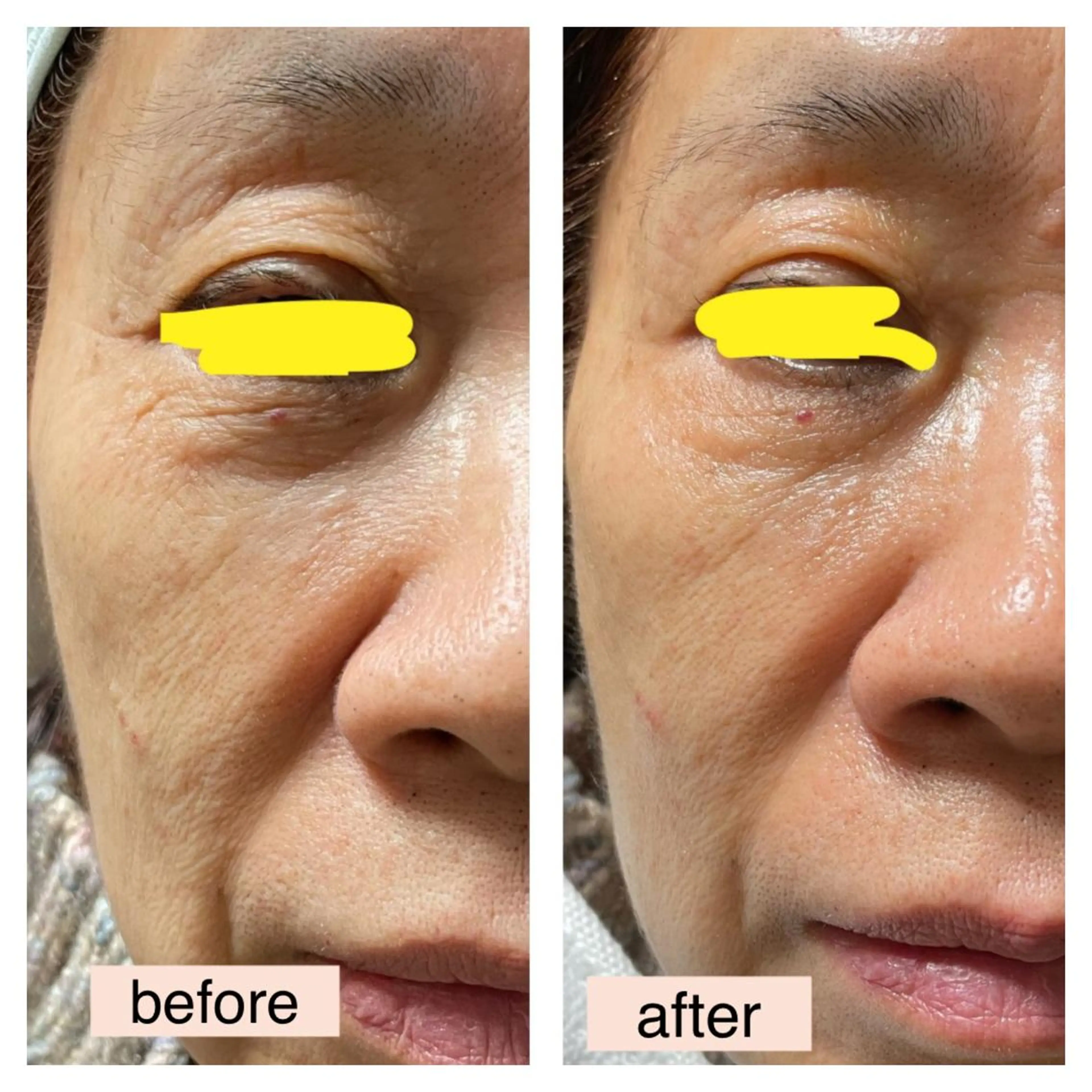 ハリ感UP超音波ソニックエステの写真