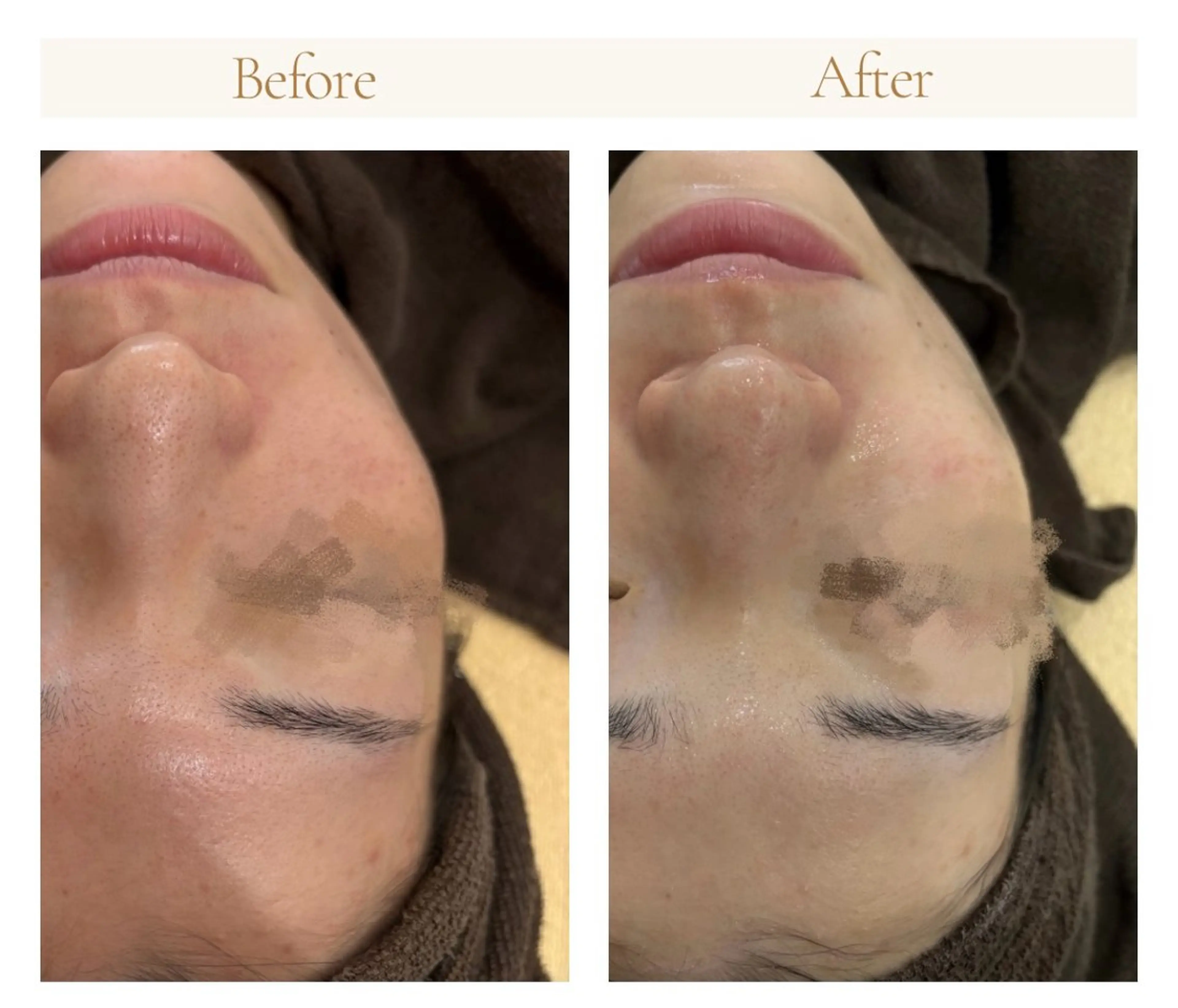 【部分ケア】気になる2ヶ所集中！選べる2パーツ毛穴洗浄（鼻＋顎/鼻＋頬/頬＋おでこなどの部位自由！）の写真