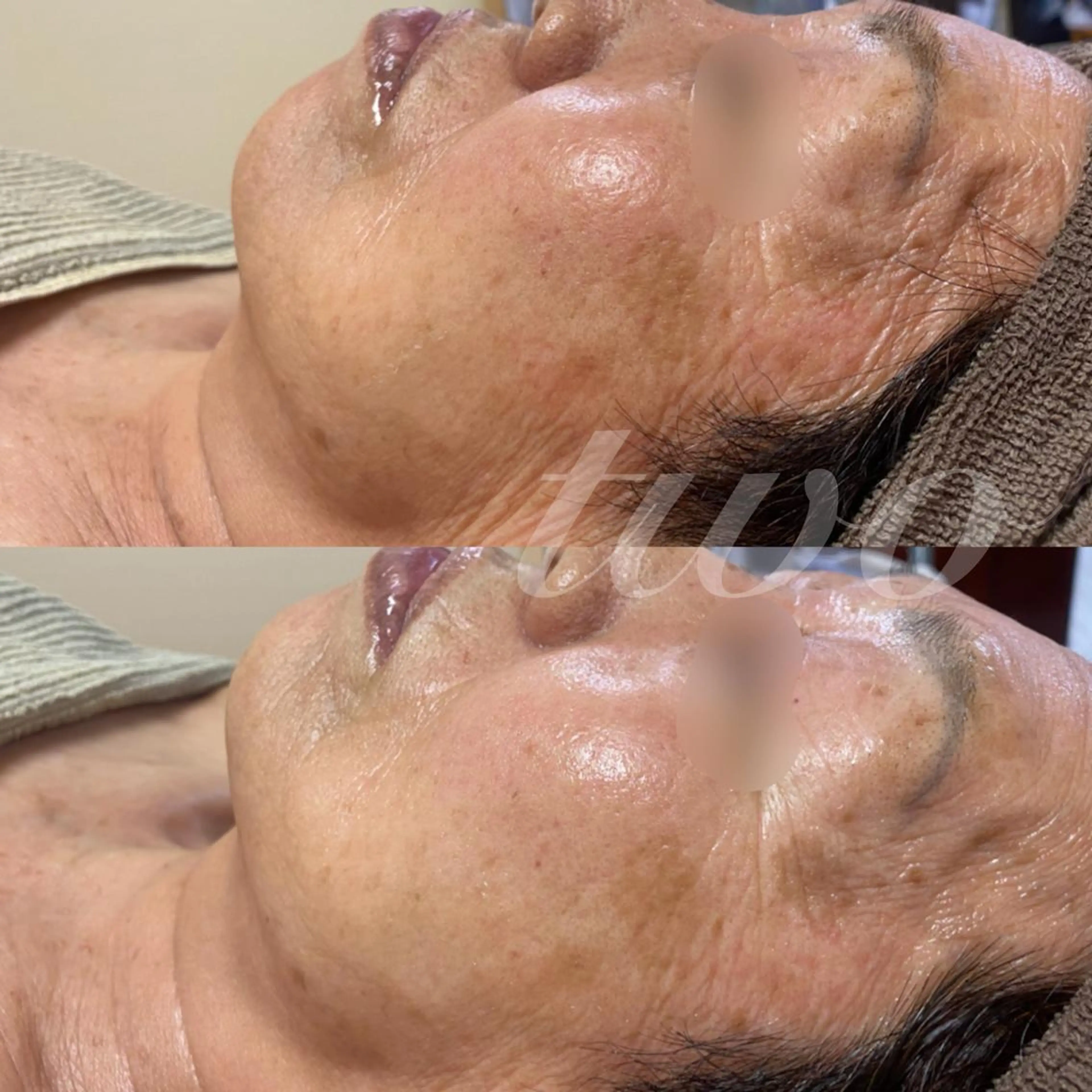 ハーブピーリング（顔+首）フェイシャルマッサージ有りの写真