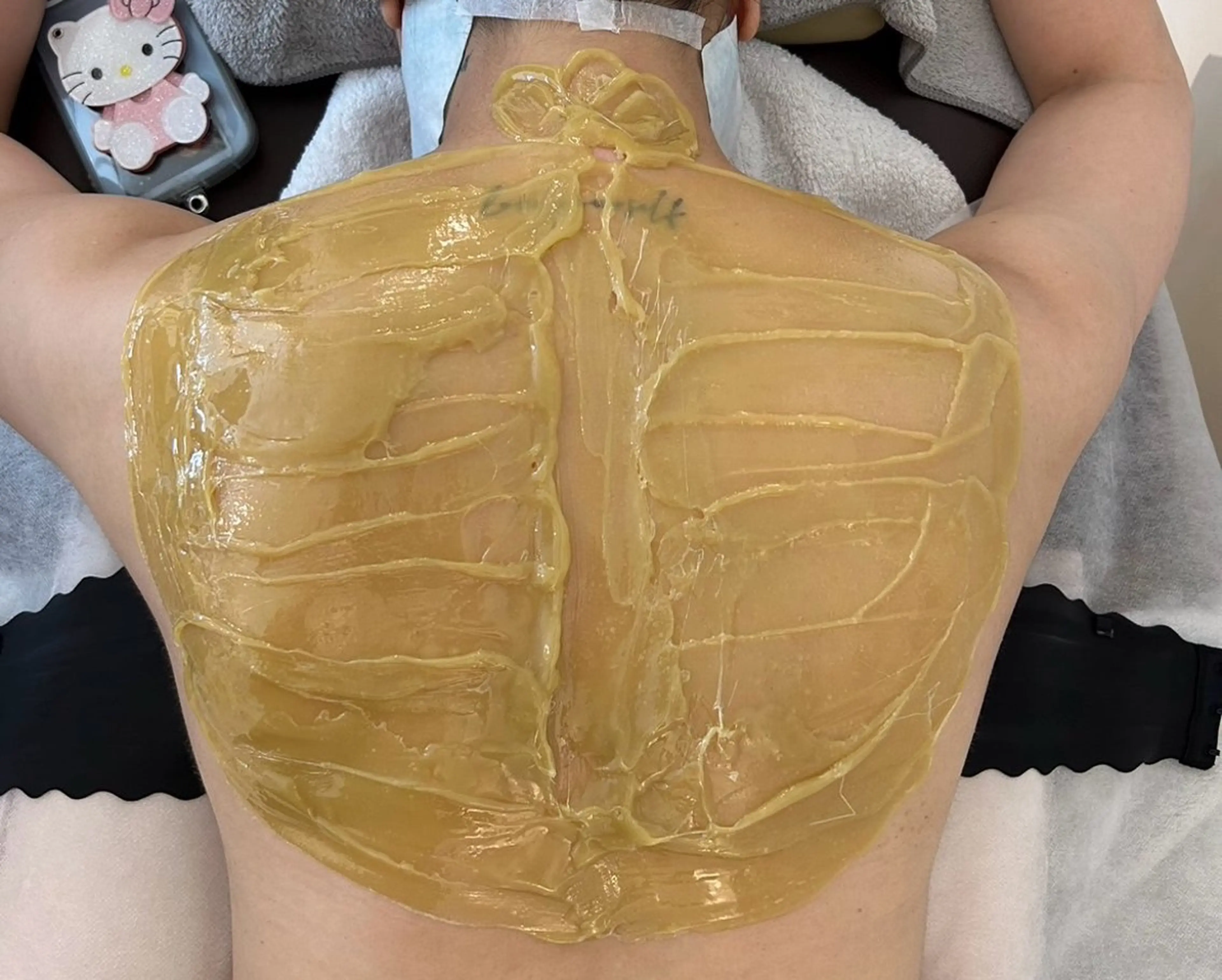 ジェルエステ(背中)➕バイオウォーミー(松ヤニ)パック(背中)の写真