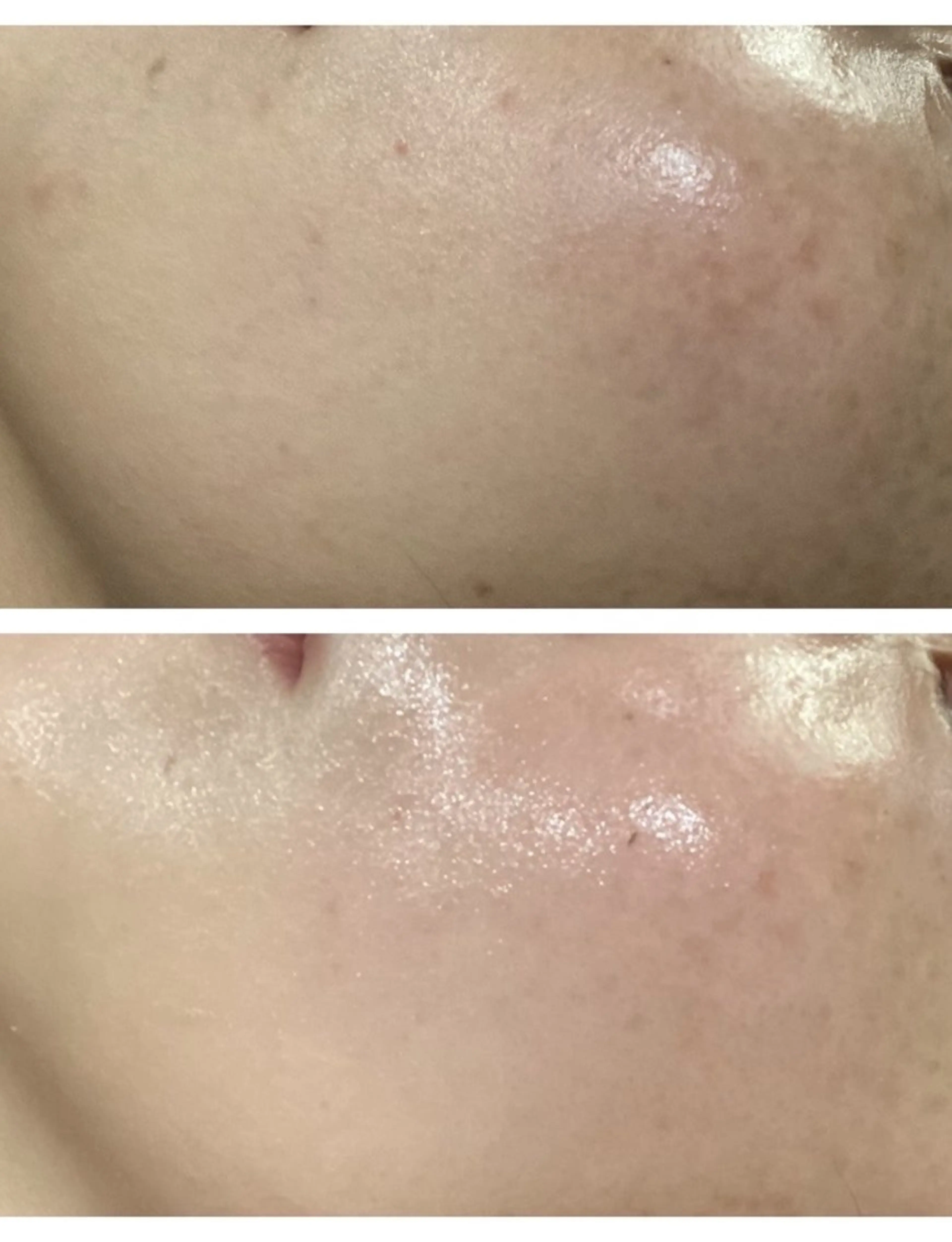 【シミケア/美白】水光肌ホワイトピール/ハイドロリンパ排泄コース¥5500✨の写真