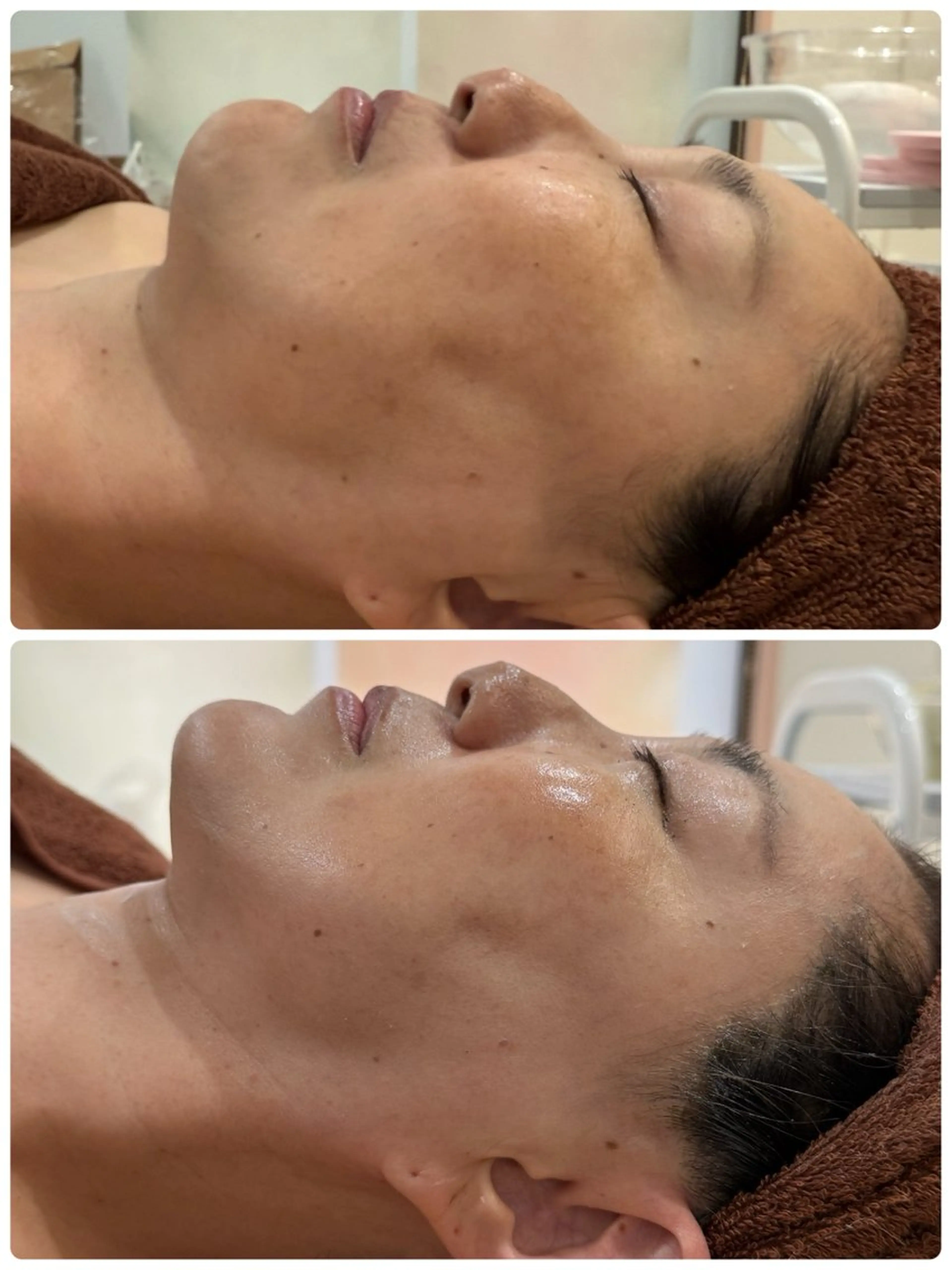 毛穴黒ずみ・テカリ除去コースの写真