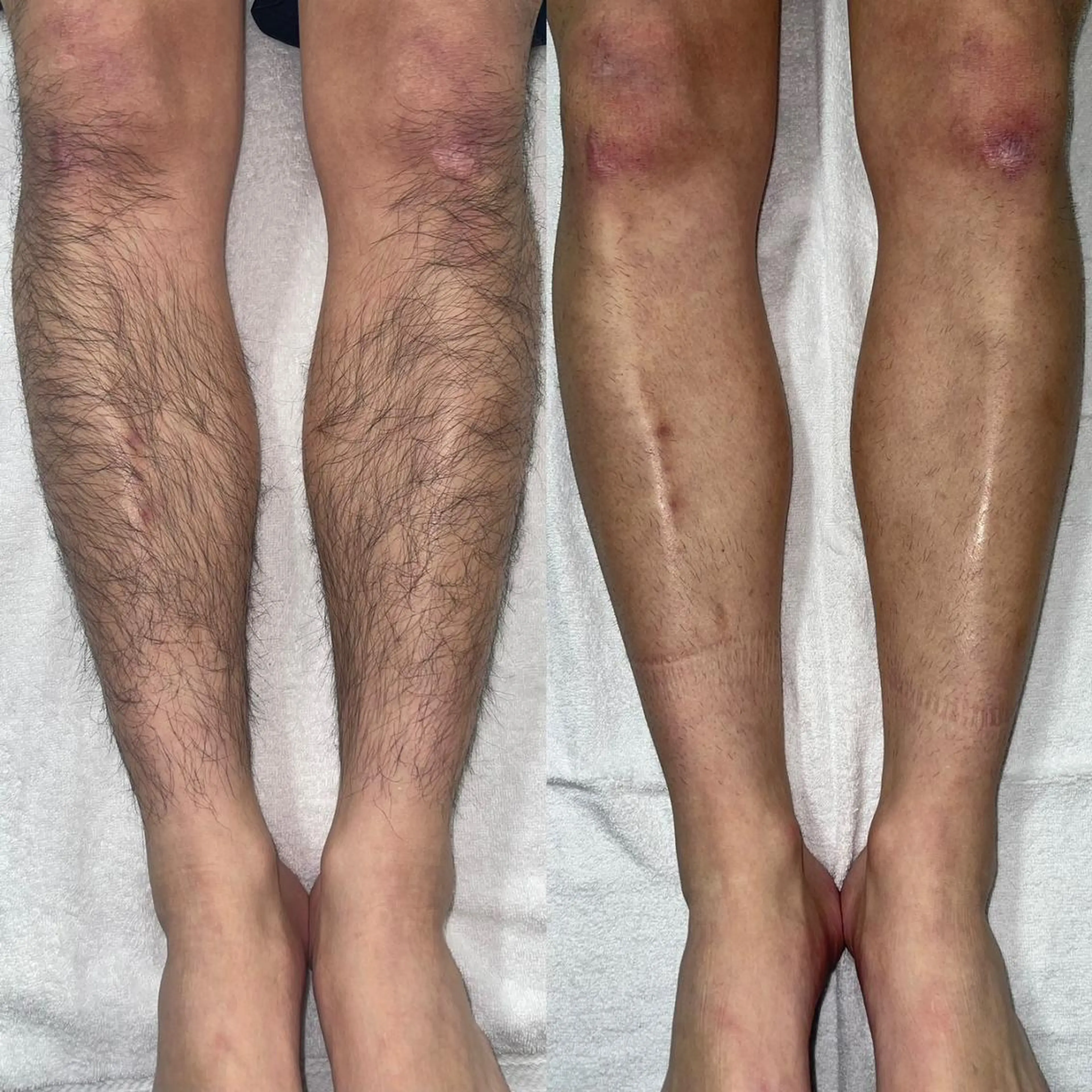 \3回目以降/  Lパーツ脱毛【足・腕・胸腹・背中】※ひとつ選択の写真