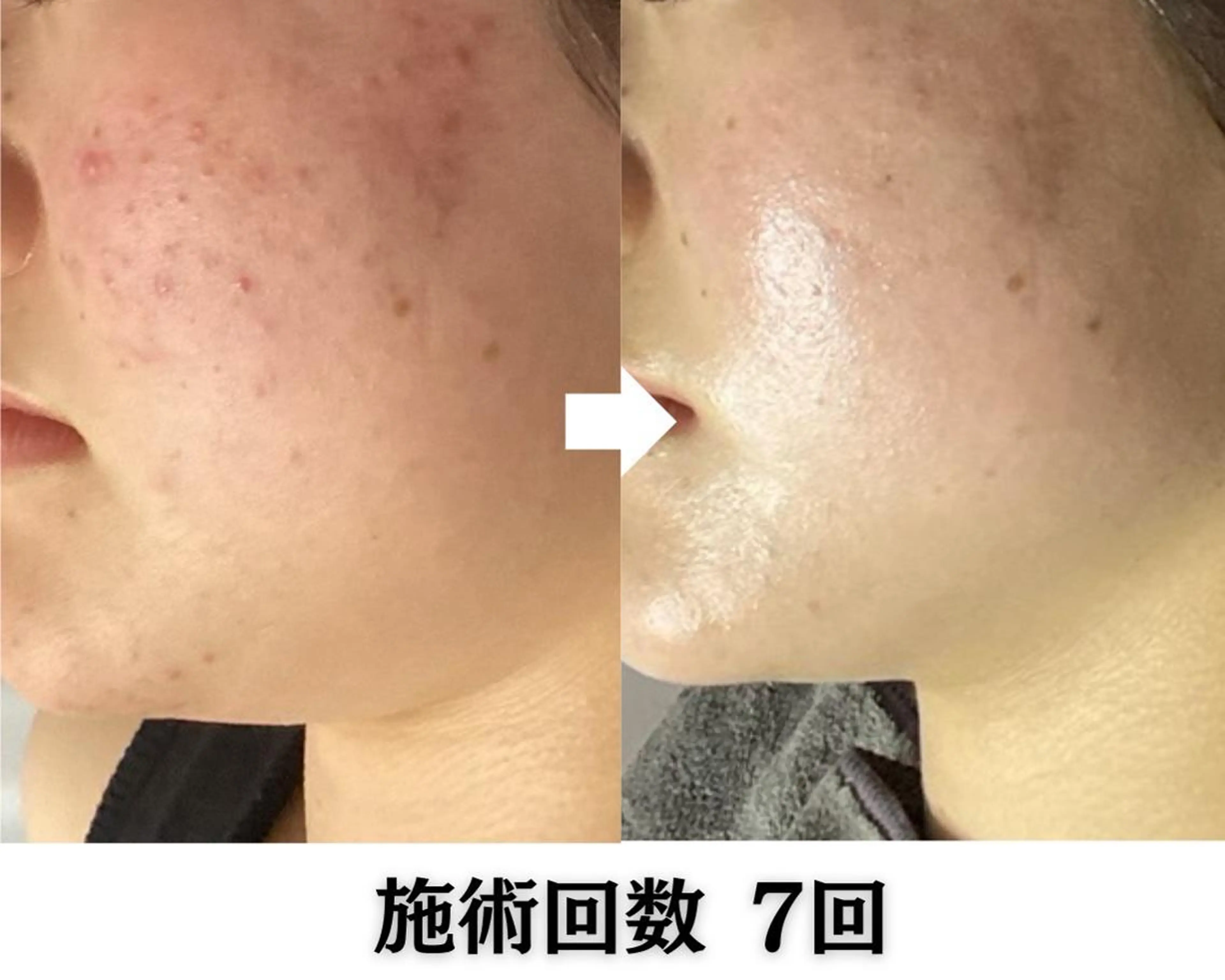 池袋毛穴ニキビ改善 ハーブピーリングのエステ・リラクイメージ