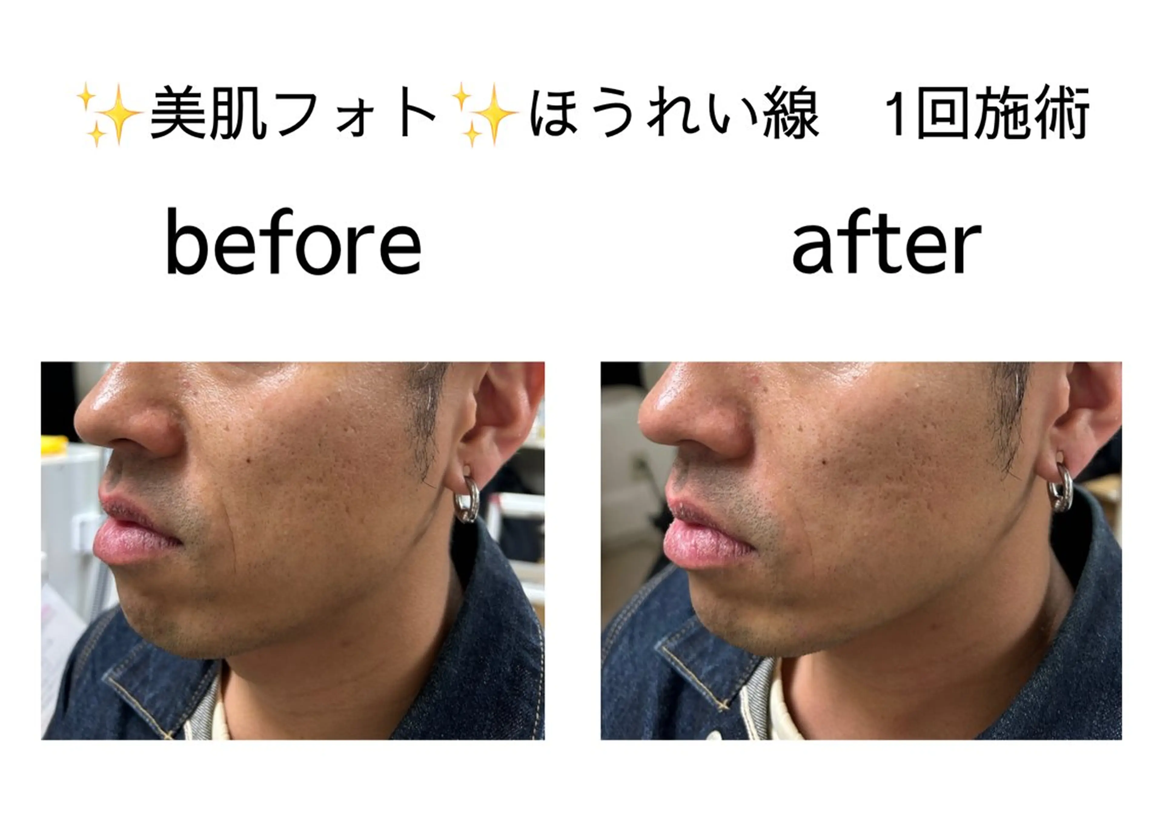 ✨美肌フォト✨ほうれい線🌈の写真