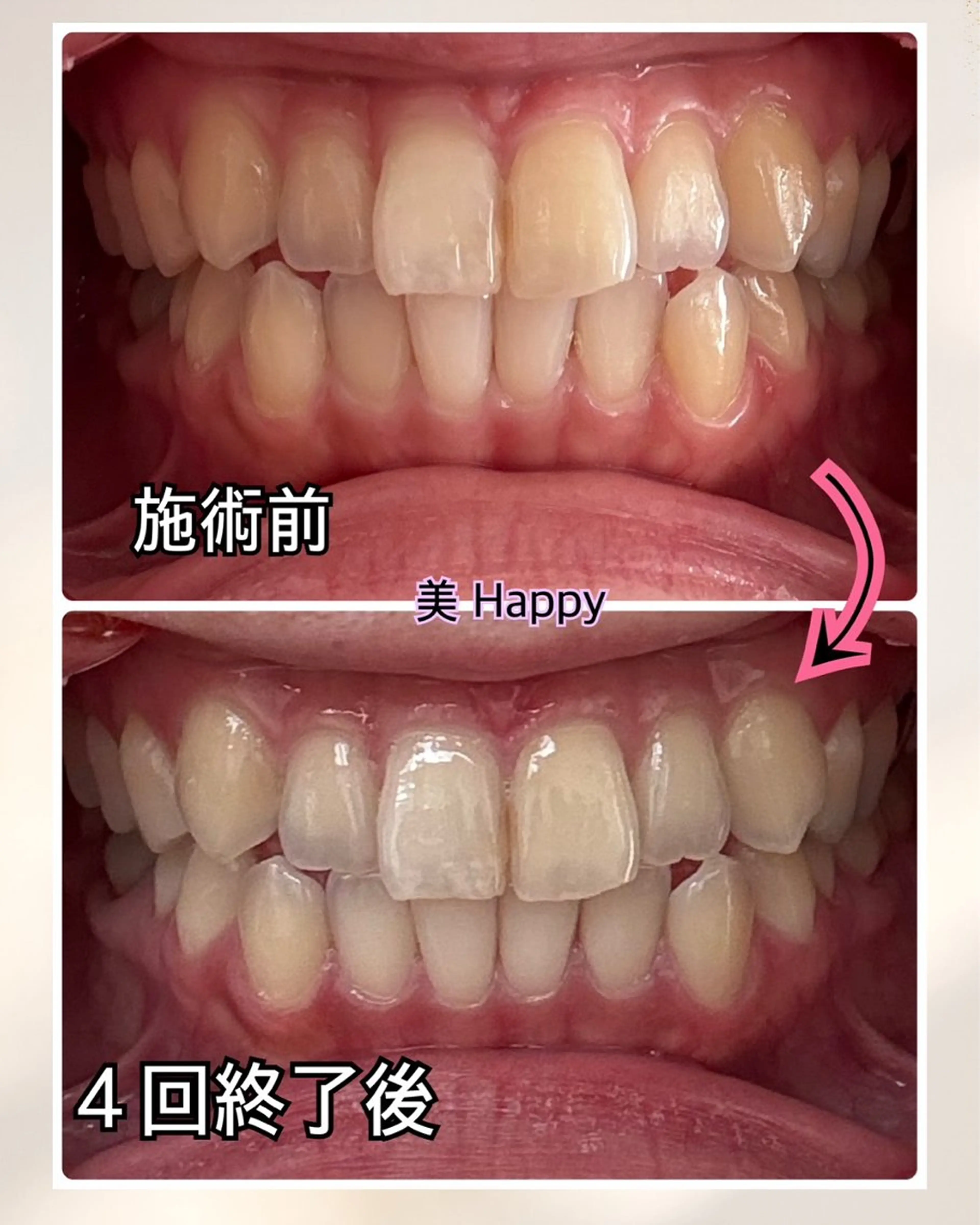 セルフホワイトニングの写真