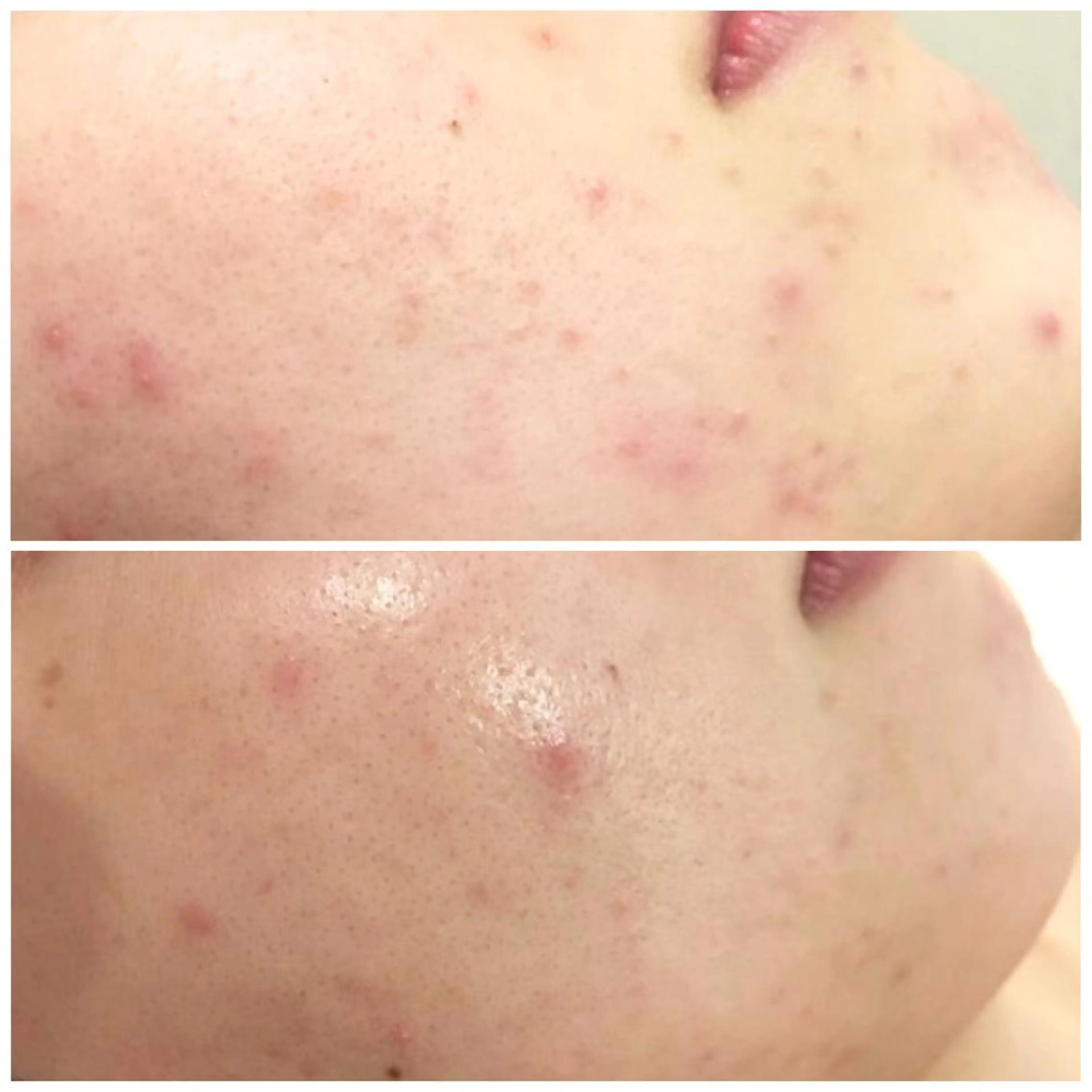 ショート カラー パーマ ヘアアレンジ メンズ キッズ ネイル マツエク・マツパ アイブロウ 🔥3か月で肌革命 🔥ニキビ専門店のエステ・リラクイメージ