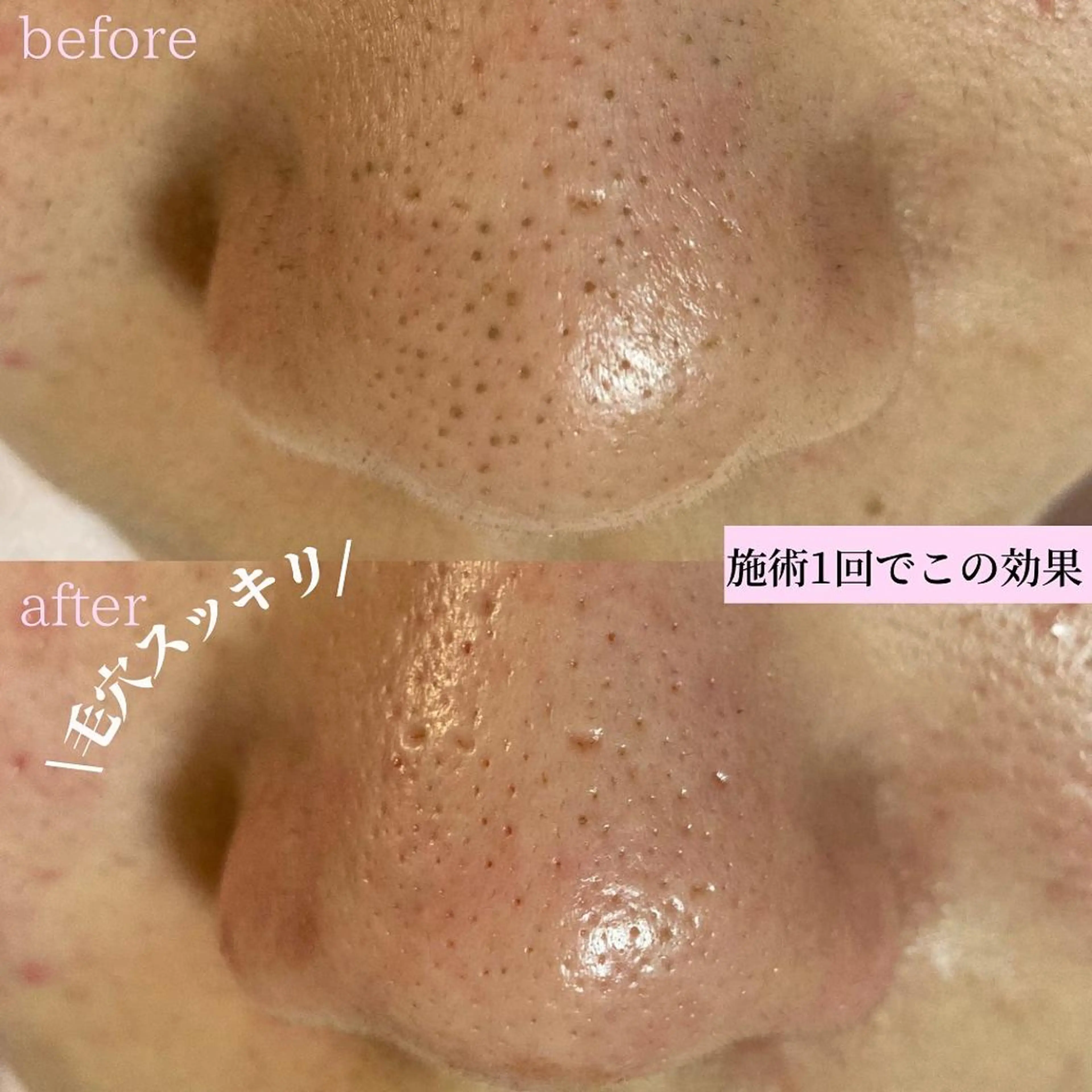 タルミ,ニキビケア専門PICHi BEAUTeピチボーテ所属・トクシゲ マホのエステ・リラクイメージ