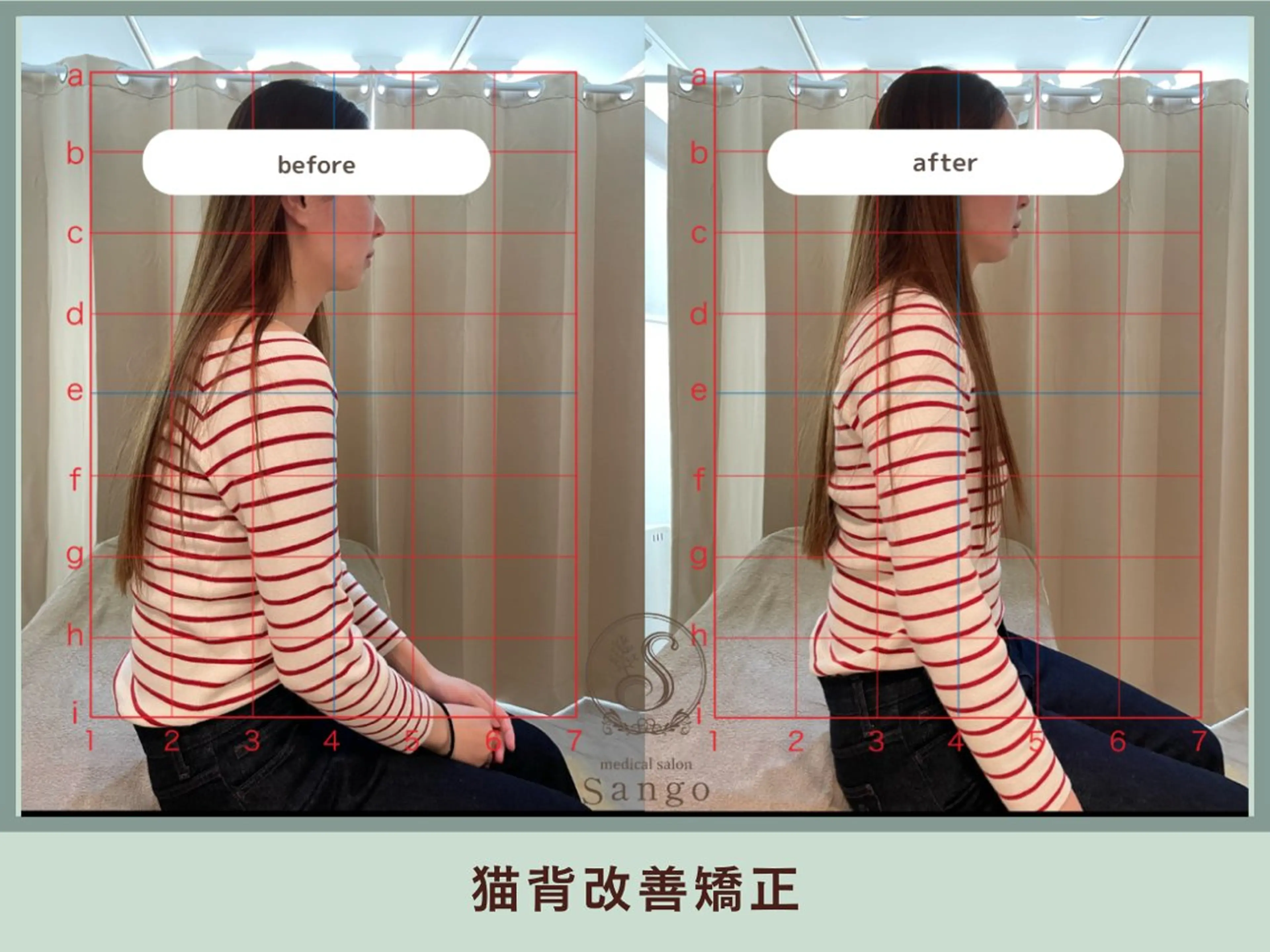 猫背改善矯正の写真