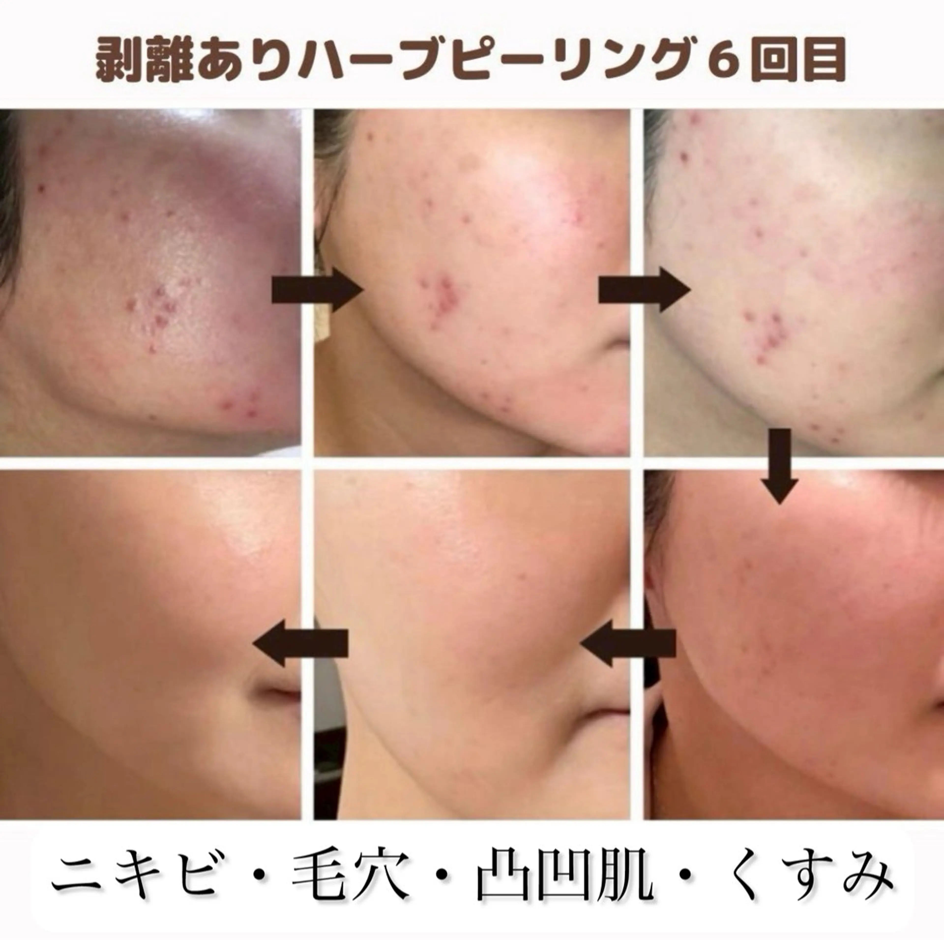 美肌ケアサロンhalu【ハーブピーリング/脱毛】所属・美肌ケアサロン halu（ハル）のその他イメージ