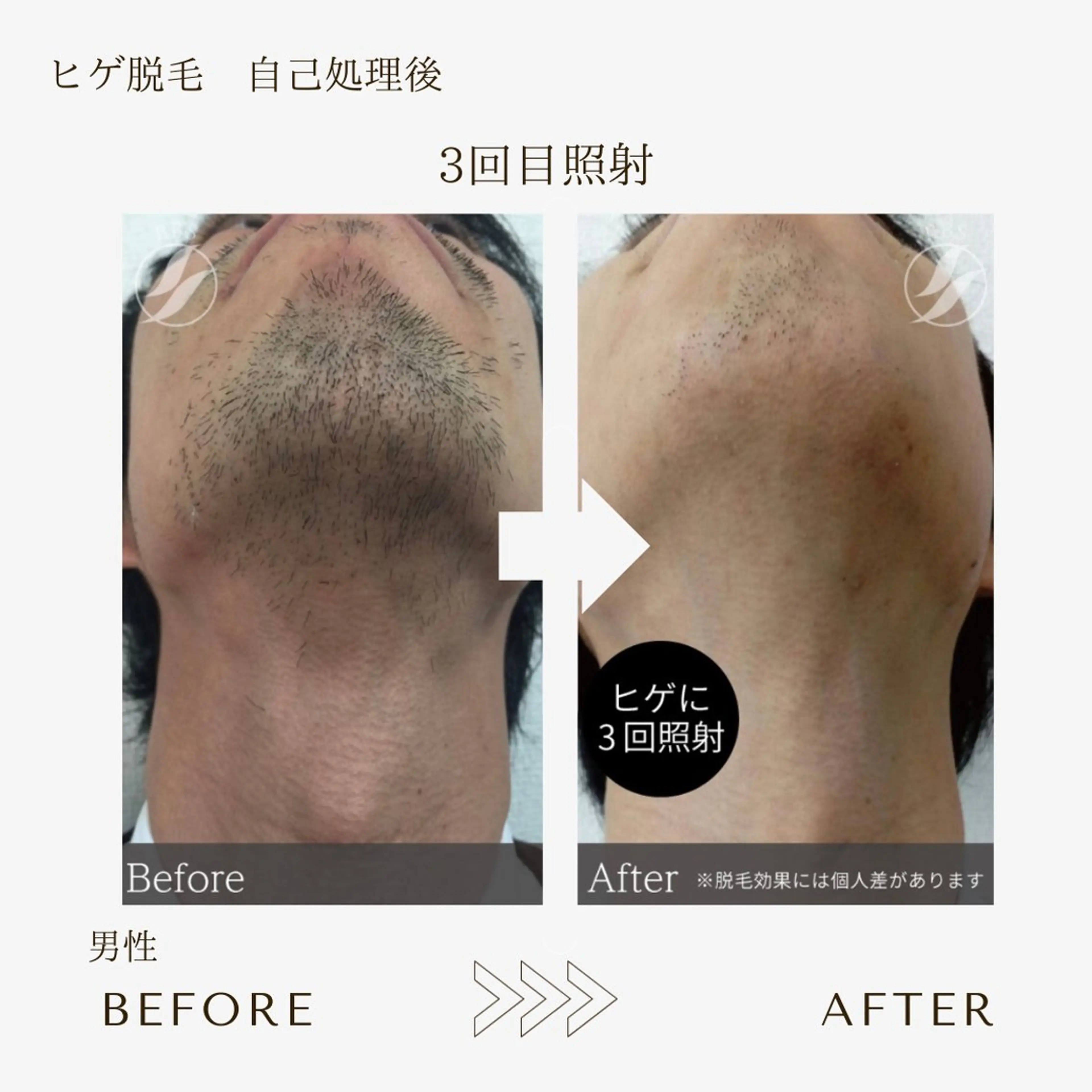 【メンズ脱毛40%off🔥】minimo特別価格🌿コラーゲン脱毛✳︎ヒゲ脱毛💎全当て、デザイン可◎ #本八幡 脱毛の写真