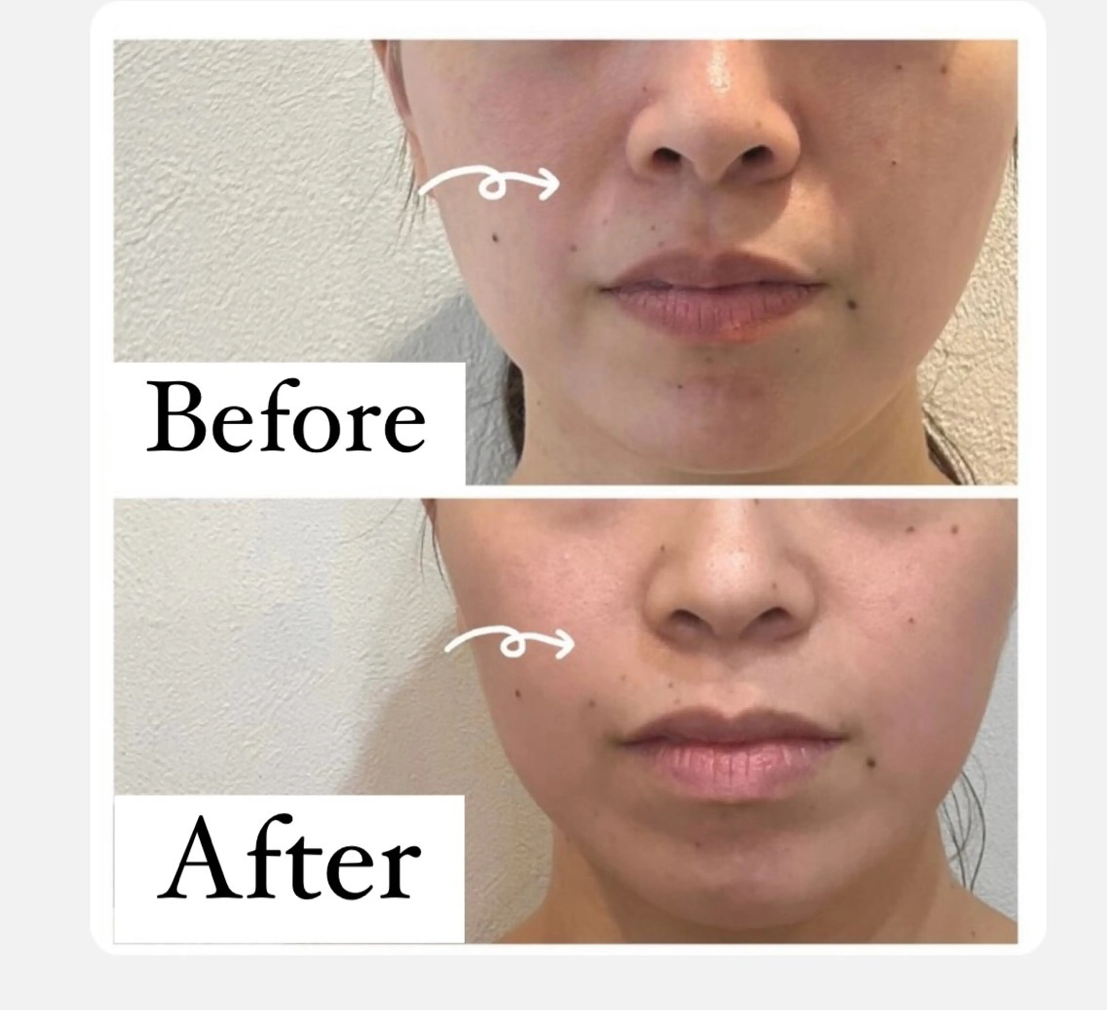 【ほうれい線、シワ、たるみ改善】立体小顔形成４Dフェイシャルの写真