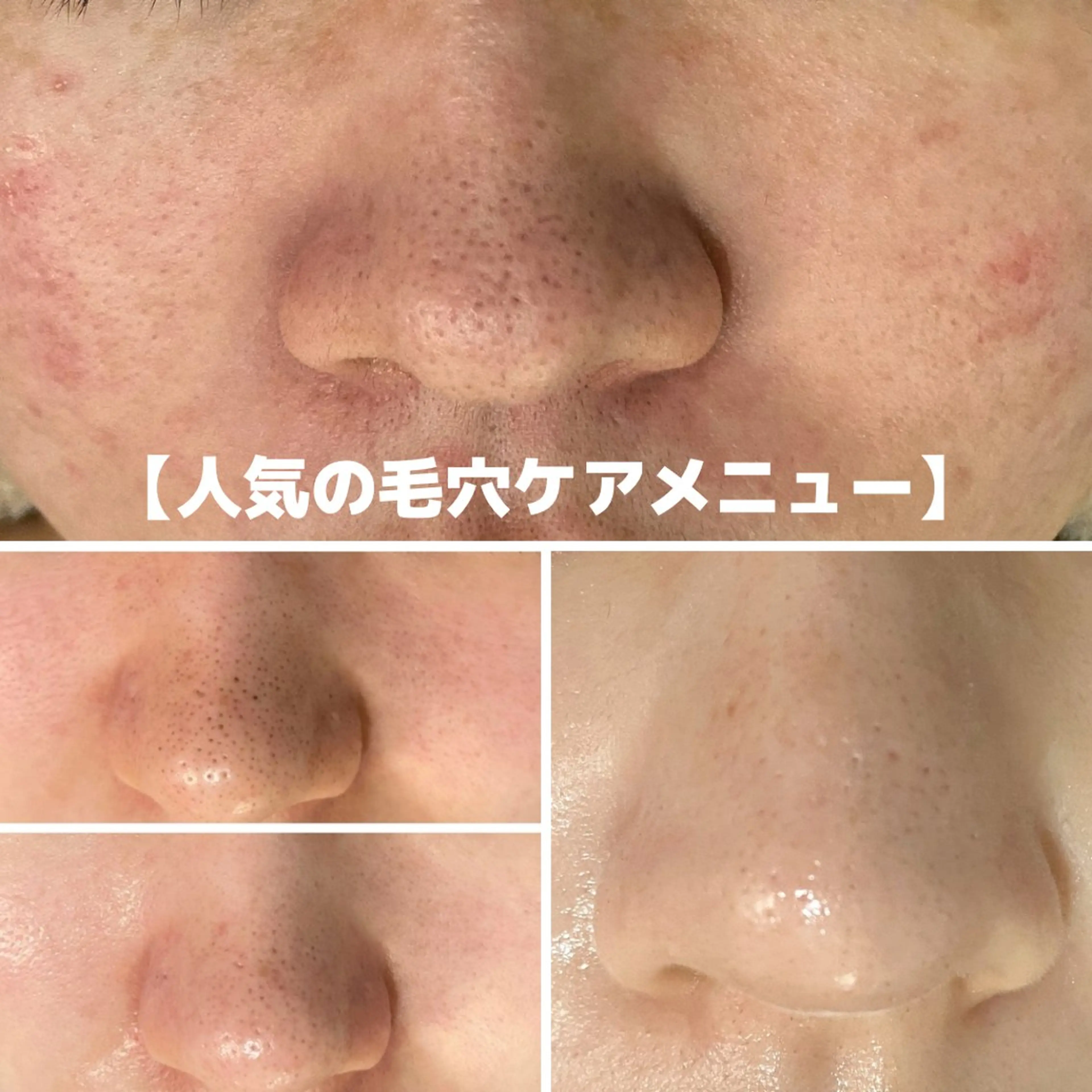 1番人気❗️毛穴の黒ずみをごっそり大掃除(全顔)の写真