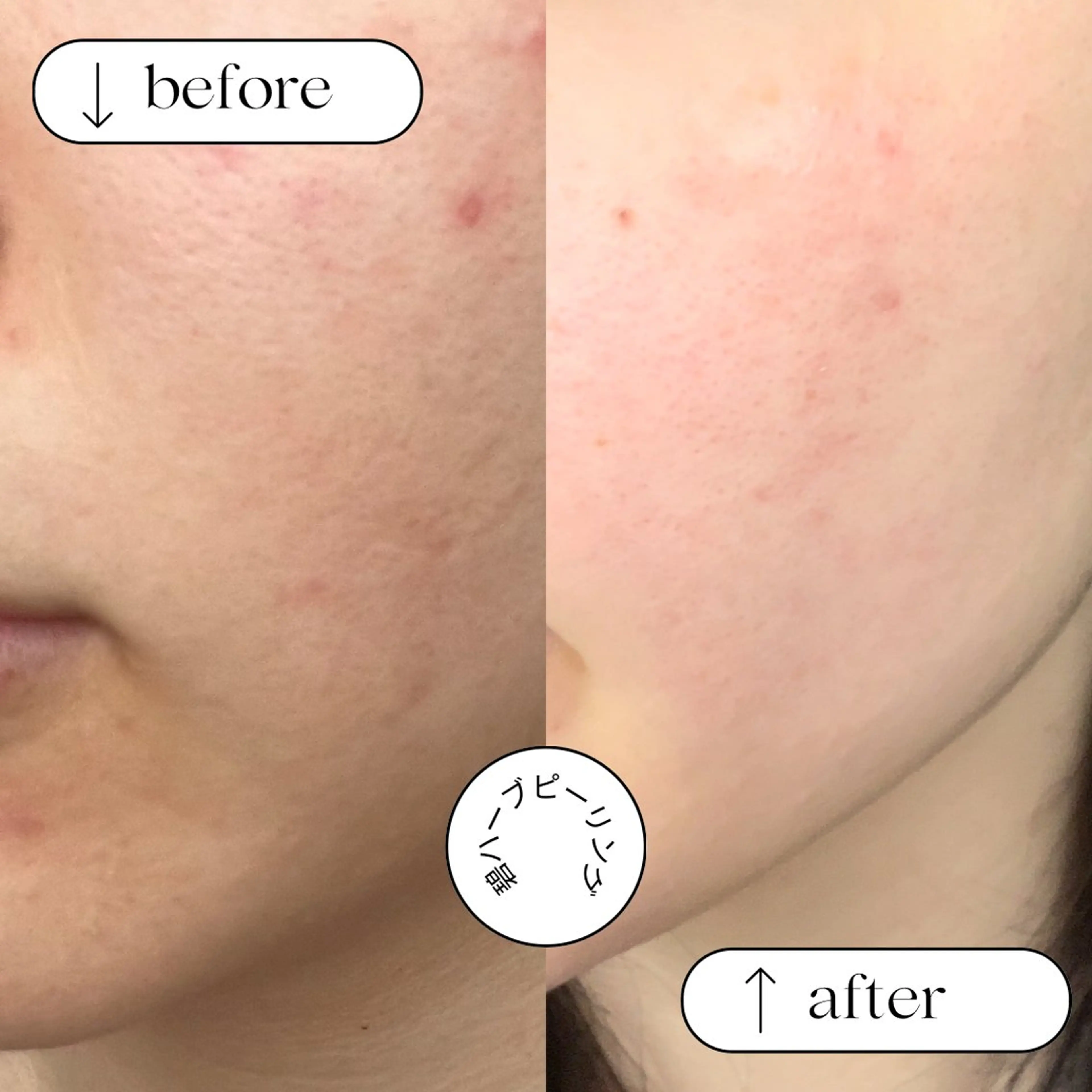 初回限定！1度で実感✨ハーブピーリング🌿ニキビ、くすみ、ハリツヤに✨剥離なしダウンタイムなし！の写真